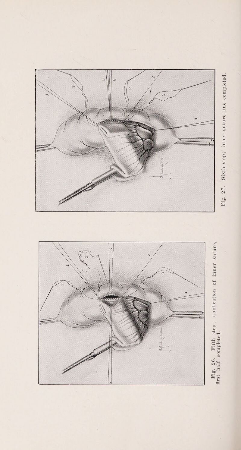 r> (M CJO Sixth step; inner suture line completed.