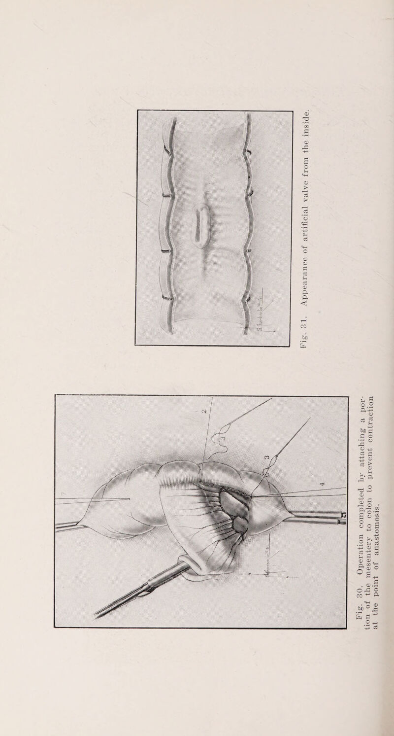 Fig. 30. Operation completed by attaching a por¬ tion of the mesentery to colon to prevent contraction at the point of anastomosis.