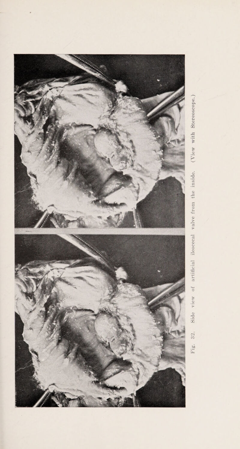 Side view of artificial ileocecal valve from the inside. (View with Stereoscope.)