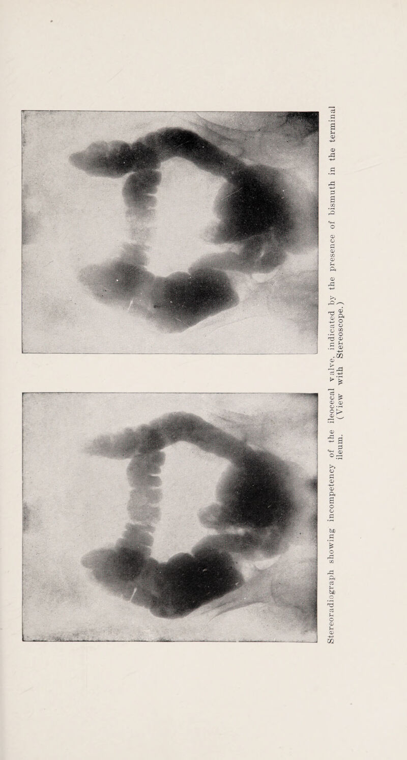 ileum. (View with Stereoscope.)