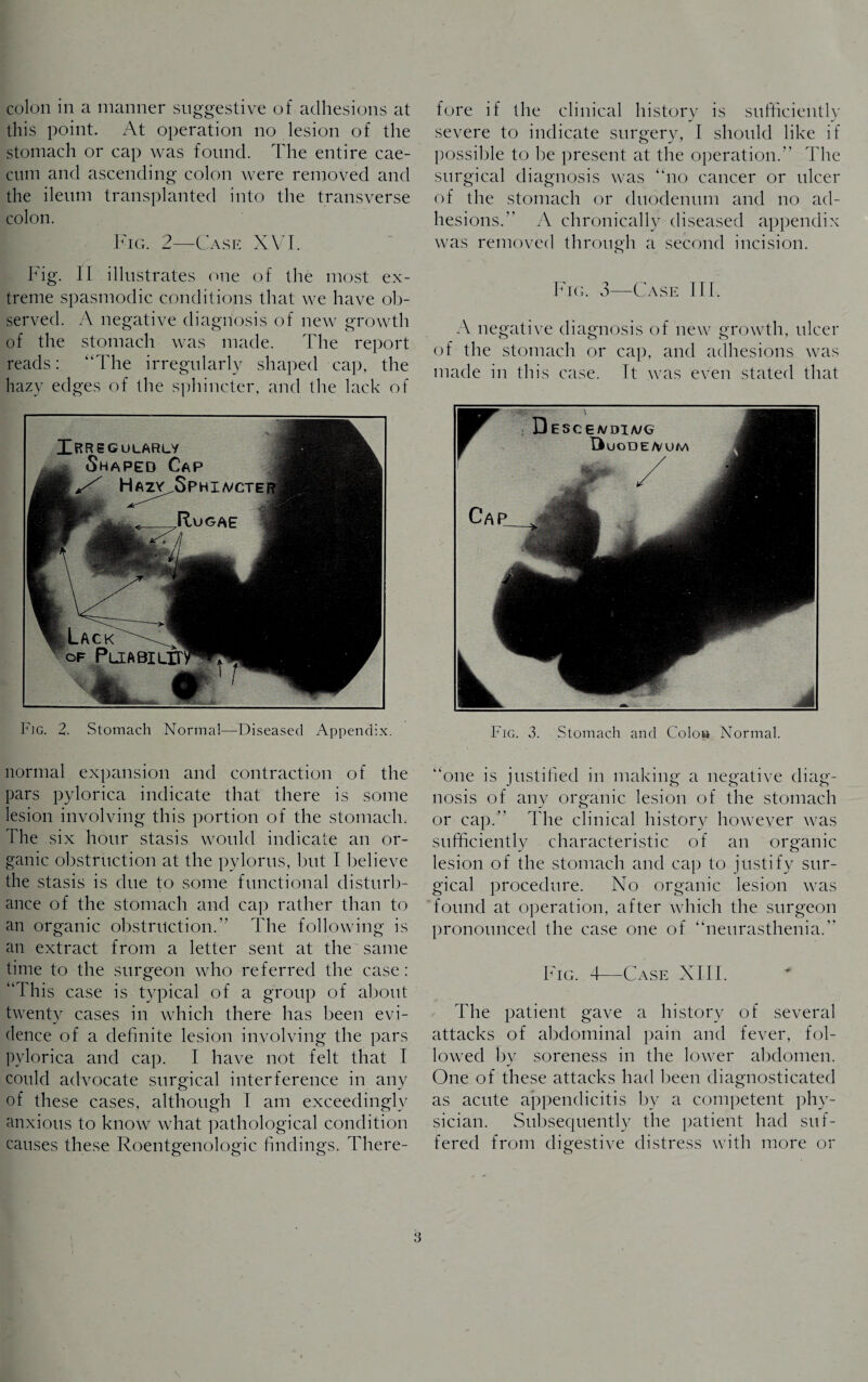 colon in a manner suggestive of adhesions at this point. At operation no lesion of the stomach or cap was found. The entire cae¬ cum and ascending colon were removed and the ileum transplanted into the transverse colon. Fig. 2—Case XVI. Fig. II illustrates one of the most ex¬ treme spasmodic conditions that we have ob¬ served. A negative diagnosis of new growth of the stomach was made. The report reads: “The irregularly shaped cap, the hazy edges of the sphincter, and the lack of Fig. 2. Stomach Norma!—Diseased Appendix. normal expansion and contraction of the pars pylorica indicate that there is some lesion involving this portion of the stomach. The six hour stasis would indicate an or¬ ganic obstruction at the pylorus, but I believe the stasis is due to some functional disturb¬ ance of the stomach and cap rather than to an organic obstruction.” The following is an extract from a letter sent at the same time to the surgeon who referred the case: “This case is typical of a group of about twenty cases in which there has been evi¬ dence of a definite lesion involving the pars pylorica and cap. I have not felt that I could advocate surgical interference in any of these cases, although I am exceedingly anxious to know what pathological condition causes these Roentgenologic findings. There¬ fore if the clinical history is sufficiently severe to indicate surgery, I should like if possible to be present at the operation.” The surgical diagnosis was “no cancer or ulcer of the stomach or duodenum and no ad¬ hesions.” A chronically diseased appendix was removed through a second incision. Fig. 3—Case III. A negative diagnosis of new growth, ulcer of the stomach or cap, and adhesions was made in this case. It was even stated that Fig. 3. Stomach and Colon Normal. “one is justified in making a negative diag¬ nosis of any organic lesion of the stomach or cap.” The clinical history however was sufficiently characteristic of an organic lesion of the stomach and cap to justify sur¬ gical procedure. No organic lesion was found at operation, after which the surgeon pronounced the case one of “neurasthenia.” Fig. 4—Case XIII. The patient gave a history of several attacks of abdominal pain and fever, fol¬ lowed by soreness in the lower abdomen. One of these attacks had been diagnosticated as acute appendicitis by a competent phy¬ sician. Subsequently the patient had suf¬ fered from digestive distress with more or