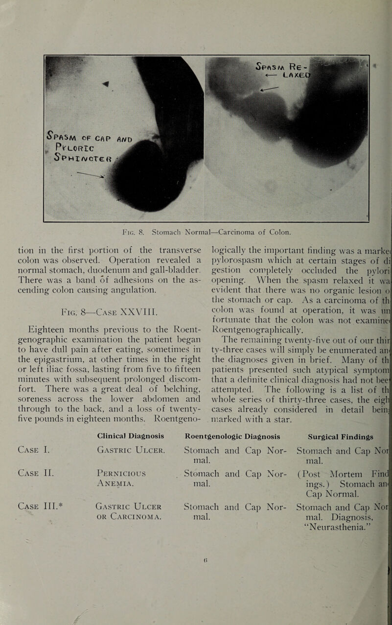 Spasm of cap PYLORIC sv MIA/ CT £ R Fig. 8. Stomach Normal—Carcinoma of Colon. tion iii the first portion of the transverse colon was observed. Operation revealed a normal stomach, duodenum and gall-bladder. There was a band of adhesions on the as¬ cending colon causing angulation. Fig. 8—Case XXVIII. Eighteen months previous to the Roent- genographic examination the patient began to have dull pain after eating, sometimes in the epigastrium, at other times in the right or left iliac fossa, lasting from five to fifteen minutes with subsequent prolonged discom¬ fort. There was a great deal of belching, soreness across the lower abdomen and through to the back, and a loss of twenty- five pounds in eighteen months. Roentgeno¬ logically the important finding was a market pylorospasm which at certain stages of di gestion completely occluded the pylori opening. When the spasm relaxed it wa evident that there was no organic lesion o the stomach or cap. As a carcinoma of th colon was found at operation, it was nn fortunate that the colon was not examine! Roentgenographically. The remaining twenty-five out of our thir ty-three cases will simply be enumerated am the diagnoses given in brief. Many of th patients presented such atypical symptom that a definite clinical diagnosis had not bee attempted. The following is a list of th whole series of thirty-three cases, the eigli cases already considered in detail beim marked with a star. Case I. Case II. Case III.* Clinical Diagnosis Roentgenologic Diagnosis Gastric Ulcer. Stomach and Cap Nor¬ mal. Pernicious Stomach and Cap Nor- Anemia. mal. Gastric Ulcer Stomach and Cap Nor- or Carcinoma. mal. Surgical Findings Stomach and Cap Nor mal. (Post Mortem Find ings.) Stomach am Cap Normal. Stomach and Cap Nori mal. Diagnosis, “Neurasthenia.”