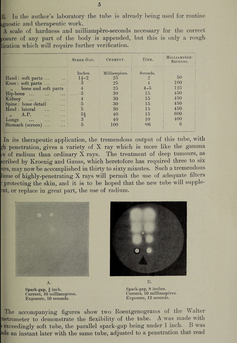 11. In the author’s laboratory the tube is already being used for routine ignostic and therapeutic work. A scale of hardness and milliampere-seconds necessary for the correct posure of any part of the body is appended, but this is only a rough lication which will require further verification. Spark-Gap. Current. Time. Milliampere- Seoonds. • Inches. Milliam peres. 25 Seconds. Hand : soft parts ... H-2 9 -J 50 Knee : soft parts ... 3 25 4 100 bone and soft parts 4 25 4-5 125 Hip-bone ... 5 30 15 450 Kidney 4 30 15 450 Spine: bone detail 5 30 15 450 Head : lateral 5 30 15 450 „ A.P. H 40 15 600 Lungs 3 40 10 400 Stomach (screen) ... 1 ■ 5 100 •06 6 In its therapeutic application, the tremendous output of this tube, with ?h penetration, gives a variety of X ray which is more like the gamma fs of radium than ordinary X rays. The treatment of deep tumours, as scribed by Kroenig and Gauss, which heretofore has required three to six urs, may now be accomplished in thirty to sixty minutes. Such a tremendous lume of highly-penetrating X rays will permit the use of adequate filters : protecting the skin, and it is to be hoped that the new tube will supple¬ st, or replace in great part, the use of radium. The accompanying figures show two Roentgenograms of the Walter Setrometer to demonstrate the flexibility of the tube. A was made with 1 exceedingly soft tube, the parallel spark-gap being under I inch. B was ade an instant later with the same tube, adjusted to a penetration that read