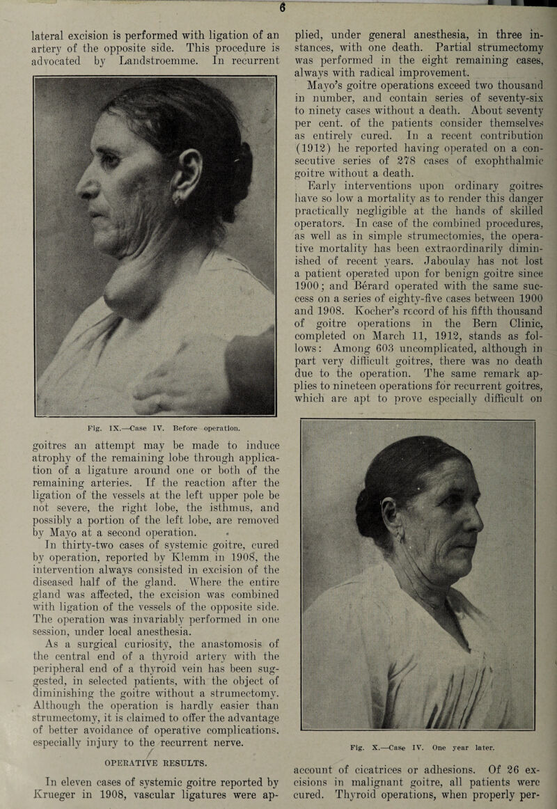 <$ lateral excision is performed with ligation of an artery of the opposite side. This procedure is advocated by Landstroemme. In recurrent Fig. IX.—'Case IV. Before operation. goitres an attempt may be made to induce atrophy of the remaining lobe through applica¬ tion of a ligature around one or both of the remaining arteries. If the reaction after the ligation of the vessels at the left upper pole be not severe, the right lobe, the isthmus, and possibly a portion of the left lobe, are removed by Mayo at a second operation. In thirty-two cases of systemic goitre, cured by operation, reported by Klemm. in 1908, the intervention always consisted in excision of the diseased half of the gland. Where the entire gland was affected, the excision was combined with ligation of the vessels of the opposite side. The operation was invariably performed in one session, under local anesthesia. As a surgical curiosity, the anastomosis of the central end of a thyroid artery with the peripheral end of a thyroid vein has been sug¬ gested, in selected patients, with the object of diminishing the goitre without a strumectomy. Although the operation is hardly easier than strumectomy, it is claimed to offer the advantage of better avoidance of operative complications, especially injury to the recurrent nerve. OPERATIVE RESULTS. In eleven cases of systemic goitre reported by Krueger in 1908, vascular ligatures were ap¬ plied, under general anesthesia, in three in¬ stances, with one death. Partial strumectomy was performed in the eight remaining cases, always with radical improvement. Mayo’s goitre operations exceed two thousand in number, and contain series of seventy-six to ninety cases without a death. About seventy per cent, of the patients consider themselves as entirelv cured. In a recent contribution (1912) he reported having operated on a con¬ secutive series of 278 cases of exophthalmic goitre without a death. Early interventions upon ordinary goitres have so low a mortality as to render this danger practically negligible at the hands of skilled operators. In case of the combined procedures, as well as in simple strumectomies, the opera¬ tive mortality has been extraordinarily dimin¬ ished of recent years. Jaboulay has not lost a patient operated upon for benign goitre since 1900; and Berard operated with the same suc¬ cess on a series of eighty-five cases between 1900 and 1908. Ivocher’s record of his fifth thousand of goitre operations in the Bern Clinic, completed on March 11, 1912, stands as fol¬ lows : Among 603 uncomplicated, although in part very difficult goitres, there was no death due to the operation. The same remark ap¬ plies to nineteen operations for recurrent goitres, which are apt to prove especially difficult on Fig. X.—Case IV. One year later. account of cicatrices or adhesions. Of 26 ex¬ cisions in malignant goitre, all patients were cured. Thyroid operations, when properly per-