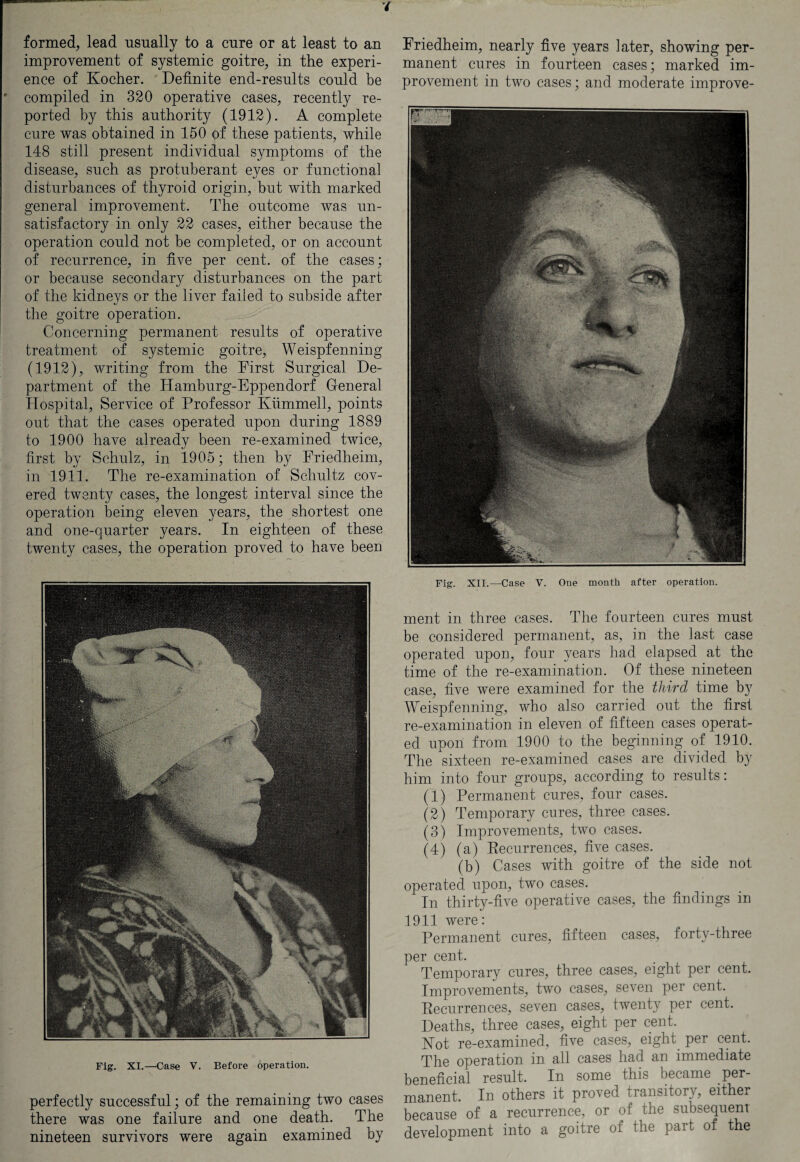 r formed, lead usually to a cure or at least to au improvement of systemic goitre, in the experi¬ ence of Kocher. Definite end-results could be compiled in 320 operative cases, recently re¬ ported by this authority (1912). A complete cure was obtained in 150 of these patients, while 148 still present individual symptoms of the disease, such as protuberant eyes or functional disturbances of thyroid origin, but with marked general improvement. The outcome was un¬ satisfactory in only 22 cases, either because the operation could not be completed, or on account of recurrence, in five per cent, of the cases; or because secondary disturbances on the part of the kidneys or the liver failed to subside after the goitre operation. Concerning permanent results of operative treatment of systemic goitre, Weispfenning (1912), writing from the First Surgical De¬ partment of the Hamburg-Eppendorf General Hospital, Service of Professor Kiimmell, points out that the cases operated upon during 1889 to 1900 have already been re-examined twice, first by Schulz, in 1905; then by Friedheim, in 1911. The re-examination of Schultz cov¬ ered twenty cases, the longest interval since the operation being eleven years, the shortest one and one-quarter years. In eighteen of these twenty cases, the operation proved to have been Fig. XI.—Case V. Before operation. perfectly successful; of the remaining two cases there was one failure and one death. The nineteen survivors were again examined by Friedheim, nearly five years later, showing per¬ manent cures in fourteen cases; marked im¬ provement in two cases; and moderate improve- Fig. XII.—Case V. One month after operation. ment in three cases. The fourteen cures must be considered permanent, as, in the last case operated upon, four years had elapsed at the time of the re-examination. Of these nineteen case, five were examined for the third time by Weispfenning, who also carried out the first re-examination in eleven of fifteen cases operat¬ ed upon from 1900 to the beginning of 1910. The sixteen re-examined cases are divided by him into four groups, according to results: (1) Permanent cures, four cases. (2) Temporary cures, three cases. (3) Improvements, two cases. (4) (a) Recurrences, five cases. (b) Cases with goitre of the side not operated upon, two cases. In thirty-five operative cases, the findings in 1911 were: Permanent cures, fifteen cases, forty-three per cent. Temporary cures, three cases, eight per cent. Improvements, two cases, seven per cent. Recurrences, seven cases, twenty per cent. Deaths, three cases, eight per cent. Hot re-examined, five cases, eight per cent. The operation in all cases had an immediate beneficial result. In some this became per¬ manent. In others it proved transitory, either because of a recurrence, or of the subsequent development into a goitre of the part of the