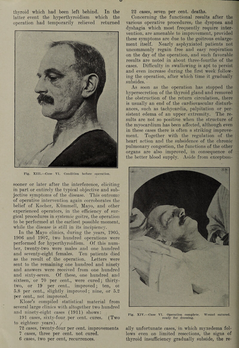 latter event the hyperthyroidism which the operation had temporarily relieved returned Fig. XIII.—Case VI. Condition before operation. sooner or later after the interference, eliciting in part or entirely the typical objective and sub¬ jective symptoms of the disease. This outcome of operative intervention again corroborates the belief of Kocher, Kummell, Mayo, and other experienced operators, in the efficiency of sur¬ gical procedures in systemic goitre, the operation to be performed at the earliest possible moment, while the disease is still in its incipiency. In the Mayo clinics, during the years, 1905, 1906 and 1907, two hundred operations were performed for hyperthyroidism. Of this num¬ ber, twenty-two were males and one hundred and seventy-eight females. Ten patients died as the result of the operation. Letters were sent to the remaining one hundred and ninety and answers were received from one hundred and sixty-seven. Of these, one hundred and sixteen, or 70 per cent., were cured; thirty- two, or 19 per cent., improved; ten, oi 5.8 per cent., slightly improved; nine, or 5.2 per cent., not improved. Klose’s compiled statistical material from several large clinics with altogether two hundred and ninety-eight cases (1911) shows: 191 cases, sixty-four per cent, cures. (Two to eighteen years), r 72 cases, twenty-four per cent, improvements. 7 cases, three per cent, not cured. 6 cases, two per cent, recurrences. Concerning the functional results after the various operative procedures, the dyspnea and dyshagia which most frequently require inter¬ vention. are amenable to improvement, provided these symptoms are due to the goitrous enlarge¬ ment itself. Nearly asphyxiated patients not uncommonly regain free and easy respiration on the day of the operation, and such favorable results are noted in about three-fourths of the cases. Difficulty in swallowing is apt to persist and even increase during the first week follow¬ ing the operation, after which time it gradually subsides. As soon as the operation has stopped the hypersecretion of the thyroid gland and removed the obstruction of the return circulation, there is usually an end of the cardiovascular disturb¬ ances, such as tachycardia, palpitation or per¬ sistent edema of an upper extremity. The re¬ sults are not so positive when the structure of the myocardium has been affected, although even in these cases there is often a striking improve¬ ment. Together with the regulation of the heart action and the subsidence of the chronic pulmonary congestion, the functions of the other organs are also improved, in consequence of the better blood supply. Aside from exception- Fig. XIV.—Case VI. Operation complete. Wound sutured. ready for dressing. ally unfortunate cases, in which myxedema fol¬ lows even on limited resections, the signs of thyroid insufficiency gradually subside, the re-