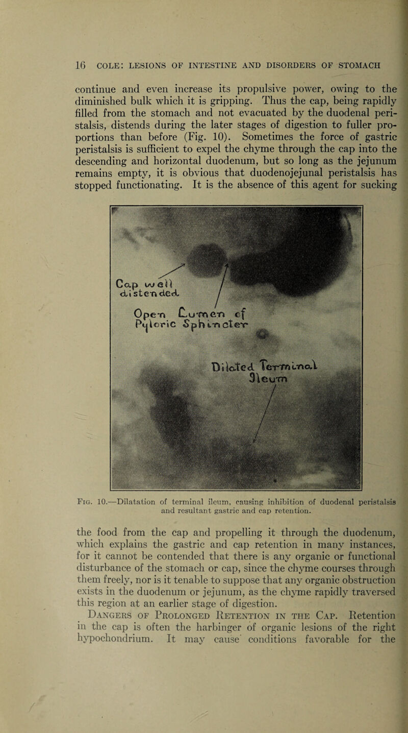 continue and even increase its propulsive power, owing to the diminished bulk which it is gripping. Thus the cap, being rapidly filled from the stomach and not evacuated by the duodenal peri¬ stalsis, distends during the later stages of digestion to fuller pro¬ portions than before (Fig. 10). Sometimes the force of gastric peristalsis is sufficient to expel the chyme through the cap into the descending and horizontal duodenum, but so long as the jejunum remains empty, it is obvious that duodenojejunal peristalsis has stopped functionating. It is the absence of this agent for sucking Fig. 10.—Dilatation of terminal ileum, causing inhibition of duodenal peristalsis and resultant gastric and cap retention. the food from the cap and propelling it through the duodenum, which explains the gastric and cap retention in many instances, for it cannot be contended that there is any organic or functional disturbance of the stomach or cap, since the chyme courses through them freely, nor is it tenable to suppose that any organic obstruction exists in the duodenum or jejunum, as the chyme rapidly traversed this region at an earlier stage of digestion. Dangers of Prolonged Retention in the Cap. Retention in the cap is often the harbinger of organic lesions of the right hypochondrium. It may cause conditions favorable for the