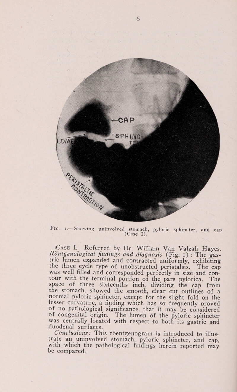 1‘IG. i. Showing uninvolved stomach, pyloric sphincter, and cap (Case I). Case I. Referred by Dr. William Van Valzah Hayes. Rontgenological findings and diagnosis (Fig. i) : The gas¬ tric lumen expanded and contracted uniformly, exhibiting the three cycle type of unobstructed peristalsis. The cap was well filled and corresponded perfectly in size and con¬ tour with the terminal portion of the pars pylorica. The space of three sixteenths inch, dividing the cap from the stomach, showed the smooth, clear cut outlines of a normal pyloric sphincter, except for the slight fold on the lesser curvature, a finding which has so frequently Droved of no pathological significance, that it may be considered of congenital origin. The lumen of the pyloric sphincter was centrally located with respect to both its gastric and duodenal surfaces. Conclusions: This roentgenogram is introduced to illus¬ trate an. uninvolved stomach, pyloric sphincter, and cap, with which the pathological findings herein reported may be compared.