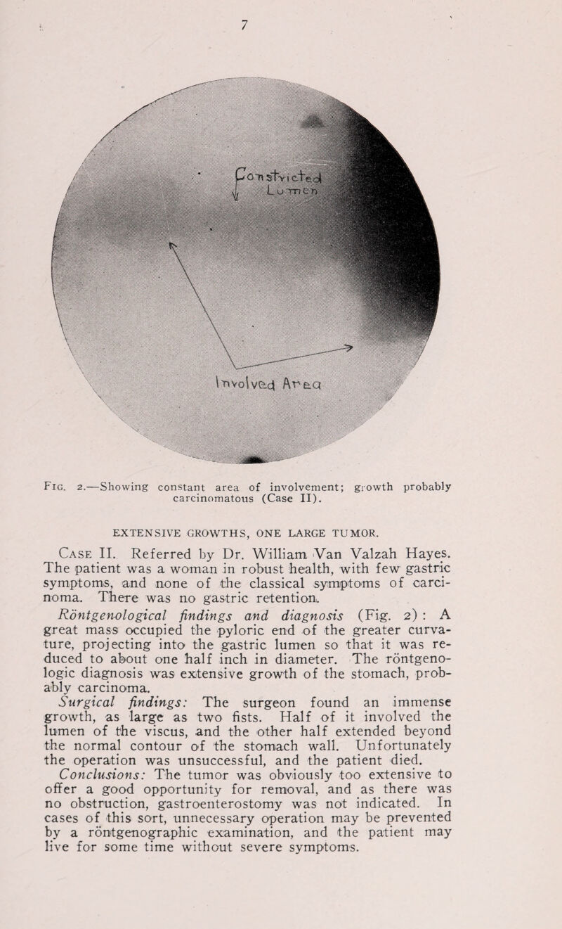 Fig. 2.—Showing constant area of involvement; carcinomatous (Case II). growth probably EXTENSIVE GROWTHS, ONE LARGE TUMOR. Case II. Referred by Dr. William Van Valzah Hayes. The patient was a woman in robust health, with few gastric symptoms, and none of the classical symptoms of carci¬ noma. There was no gastric retention. Rontgenological findings and diagnosis (Fig. 2) : A great mass occupied the pyloric end of the greater curva¬ ture, projecting into the gastric lumen so that it was re¬ duced to about one half inch in diameter. The rontgeno¬ logic diagnosis was extensive growth of the stomach, prob¬ ably carcinoma. Surgical findings: The surgeon found an immense growth, as large as two fists. Half of it involved the lumen of the viscus, and the other half extended beyond the normal contour of the stomach wall. Unfortunately the operation was unsuccessful, and the patient died. Conclusions: The tumor was obviously too extensive to offer a good opportunity for removal, and as there was no obstruction, gastroenterostomy was not indicated. In cases of this sort, unnecessary operation may be prevented by a rontgenographic examination, and the patient may live for some time without severe symptoms.