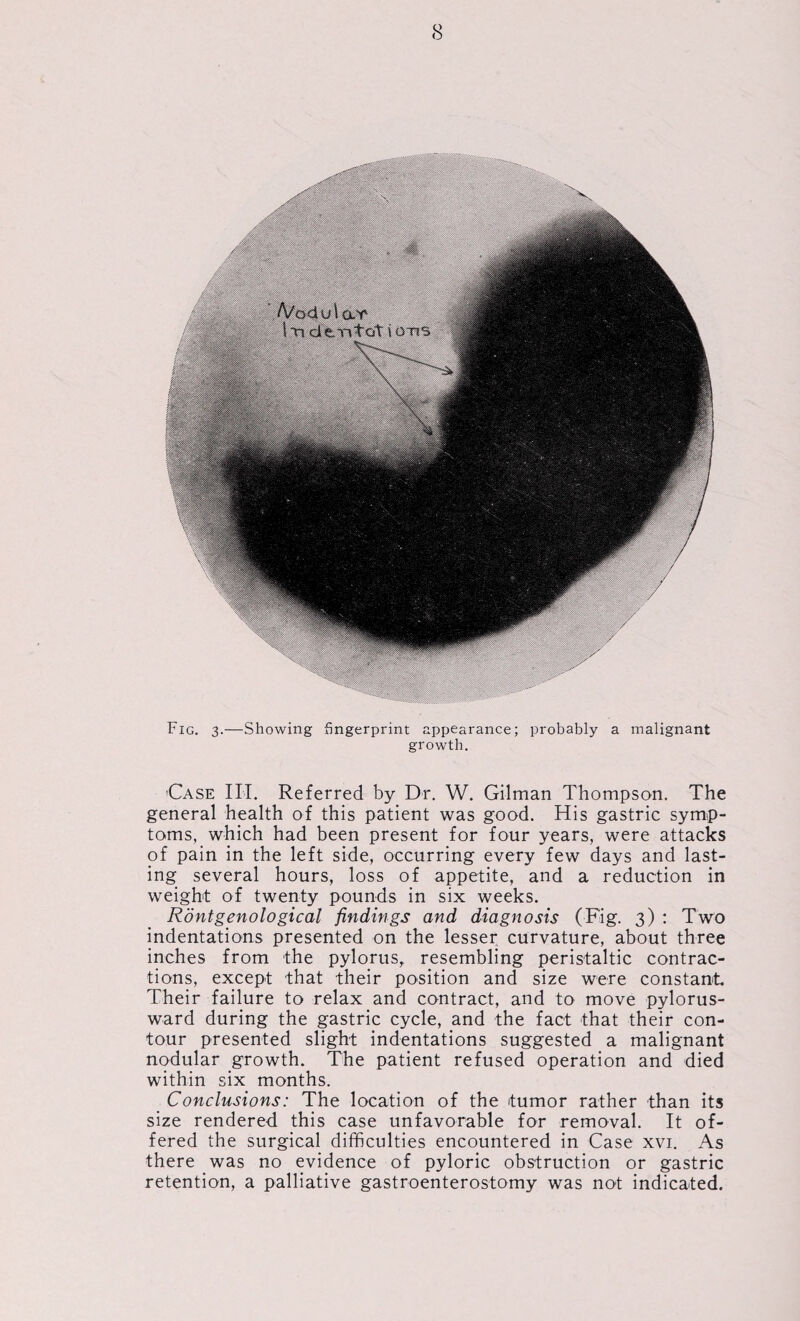 Fig. 3.—Showing fingerprint appearance; probably a malignant growth. Case III. Referred by Dr. W. Gilman Thompson. The general health of this patient was good. His gastric symp¬ toms, which had been present for four years, were attacks of pain in the left side, occurring every few days and last¬ ing several hours, loss of appetite, and a reduction in weight of twenty pounds in six weeks. Rontgenological findings and diagnosis (Fig. 3) : Two indentations presented on the lesser curvature, about three inches from the pylorus, resembling peristaltic contrac¬ tions, except that their position and size were constant Their failure to relax and contract, and to move pylorus- ward during the gastric cycle, and the fact that their con¬ tour presented slight indentations suggested a malignant nodular growth. The patient refused operation and died within six months. Conclusions: The location of the tumor rather than its size rendered this case unfavorable for removal. It of¬ fered the surgical difficulties encountered in Case xvi. As there was no evidence of pyloric obstruction or gastric retention, a palliative gastroenterostomy was not indicated.