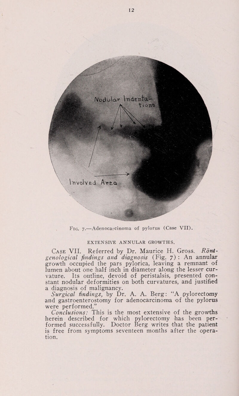 Fig. 7.—Adenocarcinoma of pylorus (Case VII). EXTENSIVE ANNULAR GROWTHS. Case VII. Referred by Dr. Maurice H. Gross. Ront- genological findings and diagnosis (Fig. 7) : An annular growth occupied the pars pylorica, leaving a remnant of lumen about one half inch in diameter along the lesser cur¬ vature. Its outline, devoid of peristalsis, presented con¬ stant nodular deformities on both curvatures, and justified a diagnosis of malignancy. Surgical findings, by Dr. A. A. Berg: “A pylorectomy and gastroenterostomy for adenocarcinoma of the pylorus were performed.” Conclusions: This is the most extensive of the growths herein described for which pylorectomy has been per¬ formed successfully. Doctor Berg writes that the patient is free from symptoms seventeen months after the opera¬