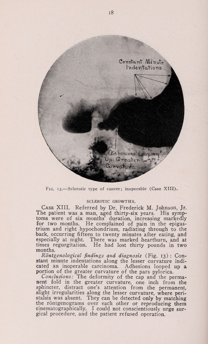 SCLEROTIC GROWTHS. Case XIII. Referred by Dr. Frederick M. Johnson, Jr. The patient was a man, aged thirty-six years. His symp¬ toms were of six months’ duration, increasing markedly for two months. He complained of pain in the epigas¬ trium and right hypochondrium, radiating through to the back, occurring fifteen to twenty minutes after eating, and especially at night. There was marked heartburn, and at times regurgitation. He had lost thirty pounds in two months. Rontgenological findings and diagnosis (Fig. 13) : Con¬ stant minute indentations along the lesser curvature indi¬ cated an inoperable carcinoma. Adhesions looped up a portion of the greater curvature of the pars pylorica. Conclusions: The deformity of the cap and the perma¬ nent fold in the greater curvature, one inch from the sphincter, distract one’s attention from the permanent, slight irregularities along the lesser curvature, where peri¬ stalsis was absent. They can be detected only by matching the rontgenograms over each other or reproducing them cinematographically. I could not conscientiously urge sur¬ gical procedure, and the patient refused operation.