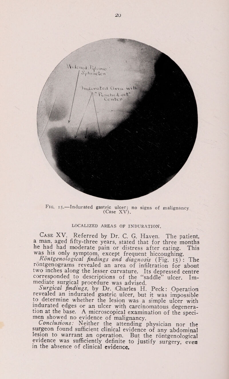 Fig. 15.—Indurated gastric ulcer; no signs of malignancy (Case XV). LOCALIZED AREAS OF INDURATION. Case XV. Referred by Dr. C. G. Haven. The patient, a man, aged fifty-three years, stated that for three months he had had moderate pain or distress after eating. This was his only symptom, except frequent hiccoughing. Rontgenological findings and diagnosis (Fig. 15) : The rontgenograms revealed an area of infiltration for about two inches along the lesser curvature. Its depressed centre corresponded to descriptions of the “saddle” ulcer. Im¬ mediate surgical procedure was advised. Surgical findings, by Dr. Charles H. Peck: Operation revealed an indurated gastric ulcer, but it was impossible to determine whether the lesion was a simple ulcer with indurated edges or an ulcer with carcinomatous degenera¬ tion at the base. A microscopical examination of the speci¬ men showed no evidence of malignancy. Conclusions: Neither the attending physician nor the surgeon found sufficient clinical evidence of any abdominal lesion to warrant an operation. But the rontgenological evidence was sufficiently definite to justify surgery, even in the absence of clinical evidence.