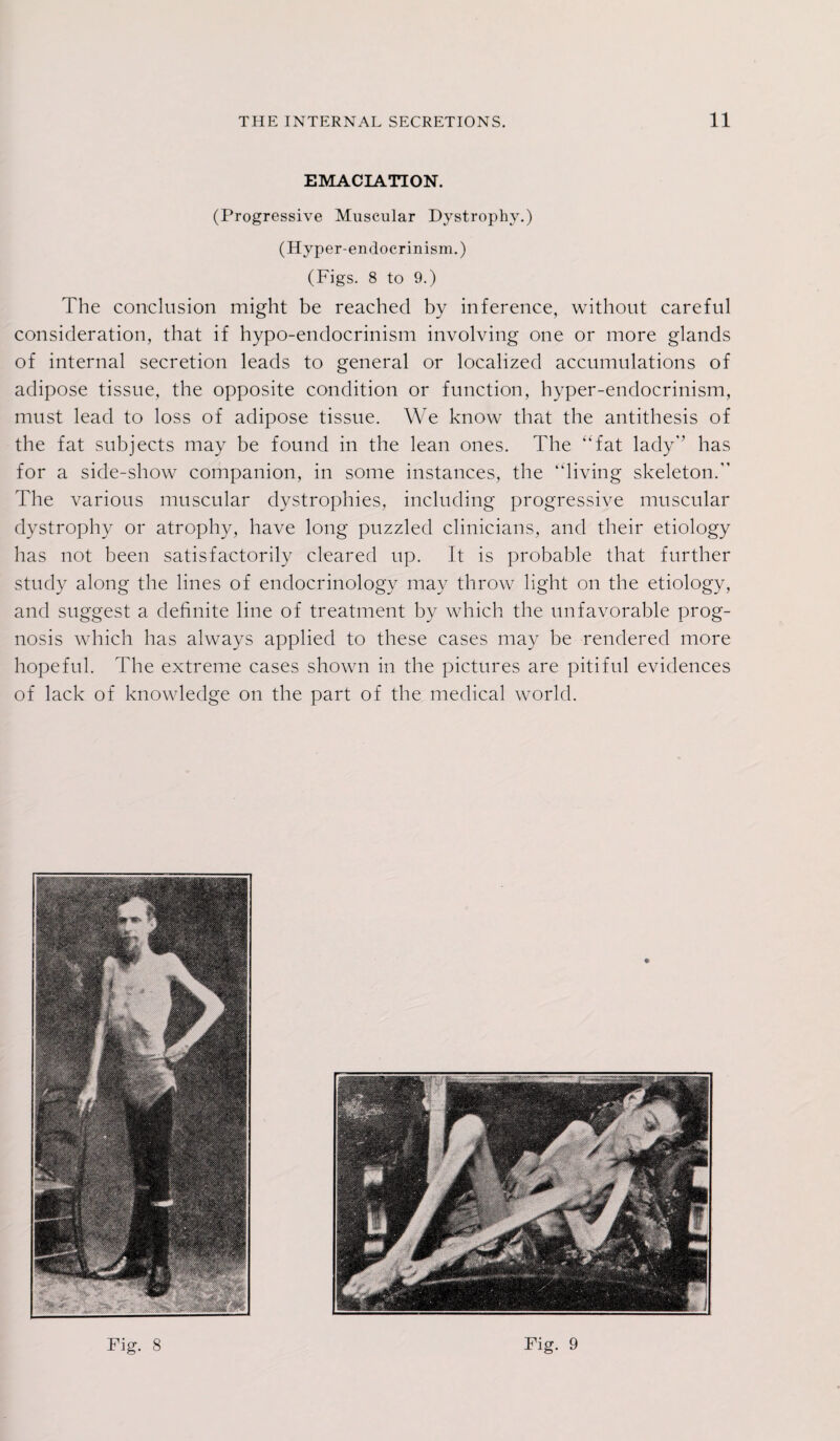 EMACIATION. (Progressive Muscular Dystrophy.) (Hyper-endocrinism.) (Figs. 8 to 9.) The conclusion might be reached by inference, without careful consideration, that if hypo-endocrinism involving one or more glands of internal secretion leads to general or localized accumulations of adipose tissue, the opposite condition or function, hyper-endocrinism, must lead to loss of adipose tissue. We know that the antithesis of the fat subjects may be found in the lean ones. The fat lady has for a side-show companion, in some instances, the “living skeleton. The various muscular dystrophies, including progressive muscular dystrophy or atrophy, have long puzzled clinicians, and their etiology has not been satisfactorily cleared up. It is probable that further study along the lines of endocrinology may throw light on the etiology, and suggest a definite line of treatment by which the unfavorable prog¬ nosis which has always applied to these cases may be rendered more hopeful. The extreme cases shown in the pictures are pitiful evidences of lack of knowledge on the part of the medical world.