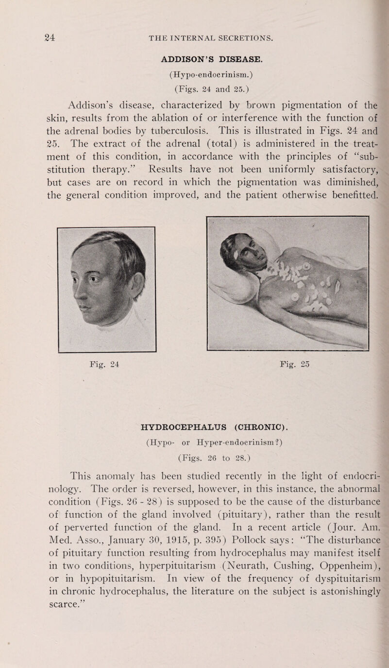 ADDISON’S DISEASE. (Hypo-endocrinism.) (Figs. 24 and 25.) Addison’s disease, characterized by brown pigmentation of the skin, results from the ablation of or interference with the function of the adrenal bodies by tuberculosis. This is illustrated in Figs. 24 and 25. The extract of the adrenal (total) is administered in the treat¬ ment of this condition, in accordance with the principles of “sub¬ stitution therapy.” Results have not been uniformly satisfactory, but cases are on record in which the pigmentation was diminished, the general condition improved, and the patient otherwise benefitted. Fig. 24 Fig. 25 HYDROCEPHALUS (CHRONIC). (Hypo- or Hyper-endocrinism?) (Figs. 26 to 28.) This anomaly has been studied recently in the light of endocri¬ nology. The order is reversed, however, in this instance, the abnormal condition (Figs. 26 - 28) is supposed to be the cause of the disturbance of function of the gland involved (pituitary), rather than the result of perverted function of the gland. In a recent article (Jour. Am. Med. Asso., January 30, 1915, p. 395) Pollock says: “The disturbance of pituitary function resulting from hydrocephalus may manifest itself in two conditions, hyperpituitarism (Neurath, Cushing, Oppenheim), or in hypopituitarism. In view of the frequency of dyspituitarism in chronic hydrocephalus, the literature on the subject is astonishingly scarce.