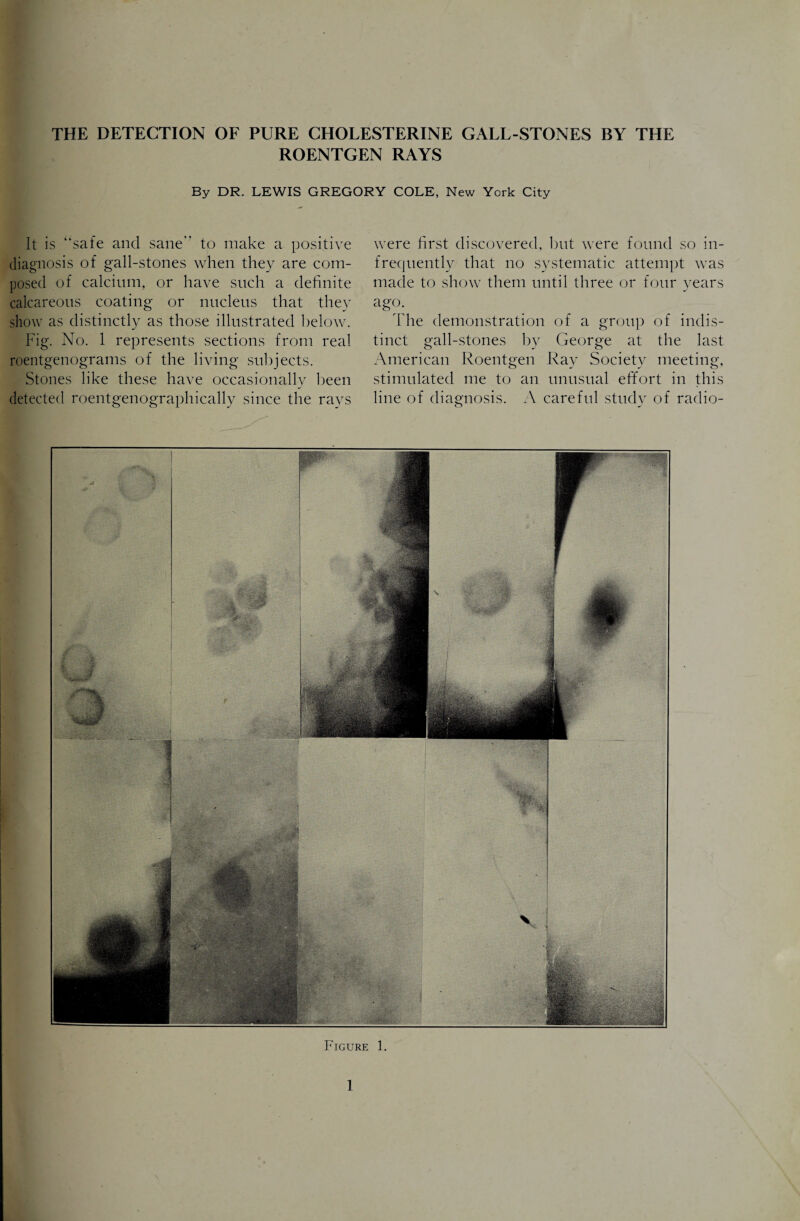 ROENTGEN RAYS By DR. LEWIS GREGORY COLE, New York City It is “safe and sane’' to make a positive diagnosis of gall-stones when they are com¬ posed of calcium, or have such a definite calcareous coating or nucleus that they show as distinctly as those illustrated below. Fig. No. 1 represents sections from real roentgenograms of the living subjects. Stones like these have occasionally been detected roentgenographically since the rays Figure 1. were first discovered, but were found so in¬ frequently that no systematic attempt was made to show them until three or four years a§‘°- The demonstration of a group of indis¬ tinct gall-stones by George at the last American Roentgen Ray Society meeting, stimulated me to an unusual effort in this line of diagnosis. A careful study of radio-