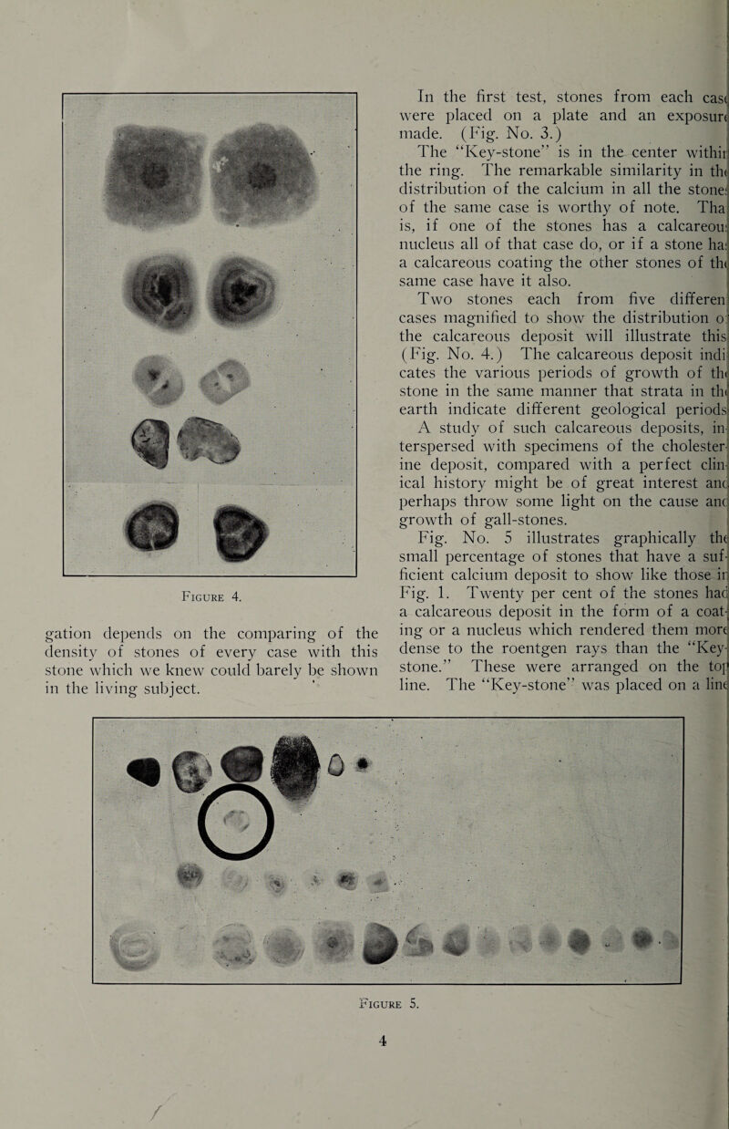 gation depends on the comparing of the density of stones of every case with this stone which we knew could barely be shown in the living subject. In the first test, stones from each cast were placed on a plate and an exposurt made. (Fig. No. 3.) The “Key-stone” is in the center withii{ the ring. The remarkable similarity in the distribution of the calcium in all the stone: of the same case is worthy of note. Tha is, if one of the stones has a calcareou: nucleus all of that case do, or if a stone ha: a calcareous coating the other stones of th<j same case have it also. Two stones each from five differen cases magnified to show the distribution o:' the calcareous deposit will illustrate this (Fig. No. 4.) The calcareous deposit indi cates the various periods of growth of th< stone in the same manner that strata in the earth indicate different geological periods- A study of such calcareous deposits, in¬ terspersed with specimens of the cholester ine deposit, compared with a perfect clin ical history might be of great interest and perhaps throw some light on the cause anc growth of gall-stones. Fig. No. 5 illustrates graphically the small percentage of stones that have a suf¬ ficient calcium deposit to show like those ir a calcareous deposit in the form of a coaF ing or a nucleus which rendered them mord dense to the roentgen rays than the “Key¬ stone. These were arranged on the top line. The “Key-stone” was placed on a lint Figure 5. 4