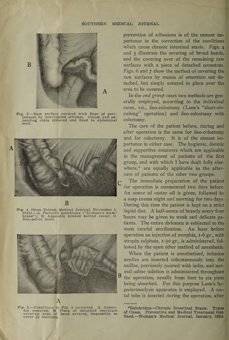 Fig. 3.—Raw surface covered with flaps of peri¬ toneum by interrupted stitches. Cecum and as¬ cending colon plicated and fixed to abdominal wall. B Fig. 4 (from British Medical Journal, November 1, 1913).—A. Pericolic membrane (“Jackson’s mem¬ brane”); B. Appendix kinked behind cecuc; C. Ileo-pelvic band. A Fig. 5.—Conditions in Fig. 4 corrected. A. Appen¬ dix removed; B. Piece of detached omentum covering area of band severed, impossible to cover by suturing. prevention of adhesions is of the utmost im¬ portance in the correction of the conditions which cause chronic intestinal stasis. Figs. 4 and 5 illustrate the severing of broad bands., and the covering over of the remaining raw surfaces with a piece of detached omentum. Figs. 6 and 7 show the method of covering the raw surfaces by means of omentum not de¬ tached, but simply sutured in place over the area to be covered. In the end group cases two methods are gen¬ erally employed, according to the individual cases, viz., ileo-colostomy (Lane’s “short-cir¬ cuiting” operation) and ileo-colostomy with colectomy. The care of the patient before, during and after operation is the same for ileo-colostomy and for colectomy. It is of the utmost im¬ portance in either case. The hygienic, dietetic and supportive measures which are applicable in the management of patients of the first group, and with which I have dealt fully else¬ where,* are equally applicable in the after¬ care of patients of the other two groups. The immediate preparation of the patient for operation is commenced two days before. An ounce of castor oil is given, followed by a soap enema night and morning for two days. During this time the patient is kept on a strict liquid diet. A half-ounce of brandy every four hours may be given to weak and delicate pa¬ tients. The entire abdomen is subjected to the most careful sterilization. An hour before operation an injection of morphia, 1-6 gr., with atropin sulphate, 1-50 gr., is administered, fol¬ lowed by the open ether method of anesthesia. When the patient is anesthetized, infusion needles are inserted subcutaneously into the axillae, previously painted with iodin, and nor¬ mal saline solution is administered throughout the operation, usually from four to six pints being absorbed. For this purpose Lane’s hy- podermoclysis apparatus is employed. A rec¬ tal tube is inserted during the operation, after *Bainbridge—Chronic Intestinal Stasis. Types of Cases. Preventive and Medical Treatment Out¬ lined.—Woman’s Medical Journal, January, 1914.