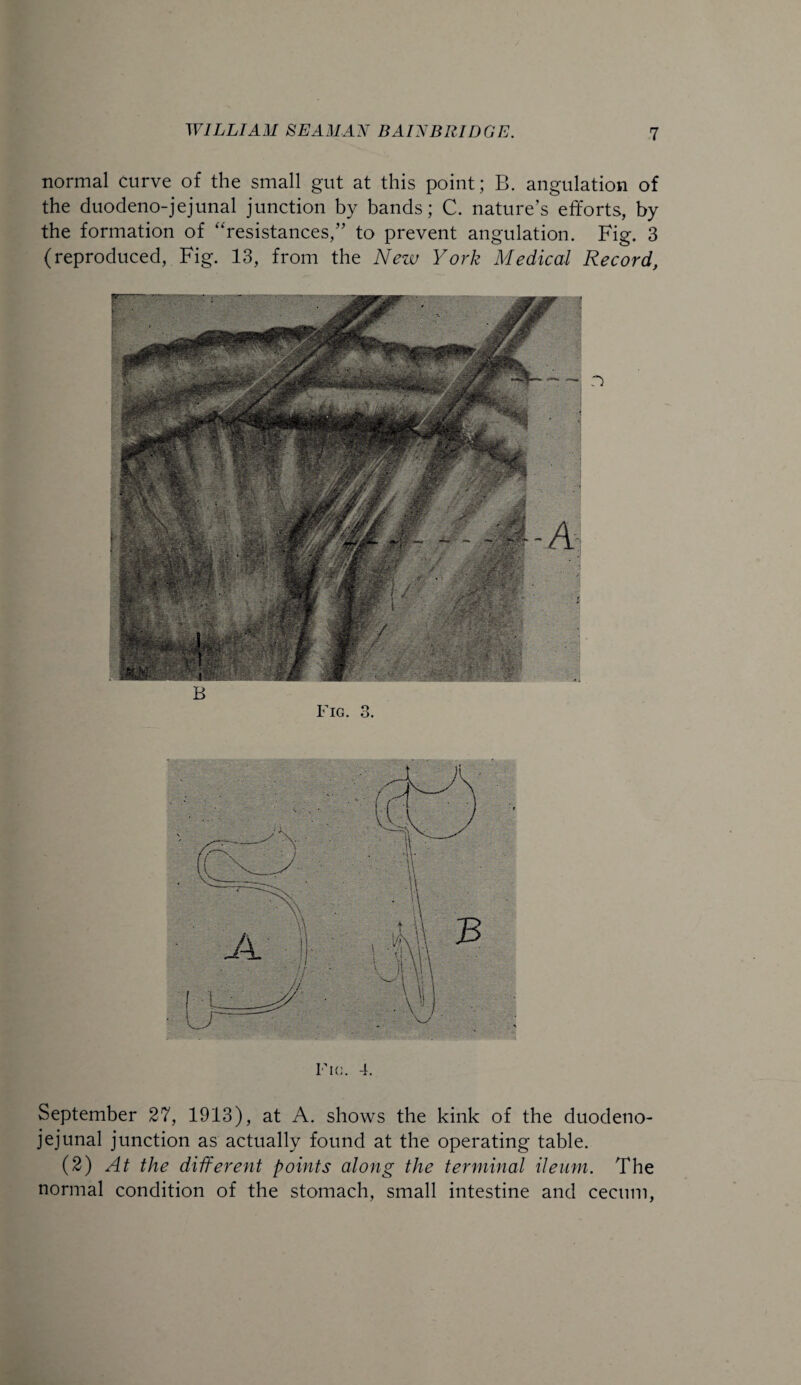 normal curve of the small gut at this point; B. angulation of the duodeno-jejunal junction by bands; C. nature’s efforts, by the formation of “resistances,” to prevent angulation. Fig. 3 (reproduced, Fig. 13, from the New York Medical Record, Fig. 4. September 27, 1913), at A. shows the kink of the duodeno¬ jejunal junction as actually found at the operating table. (2) At the different points along the terminal ileum. The normal condition of the stomach, small intestine and cecum,