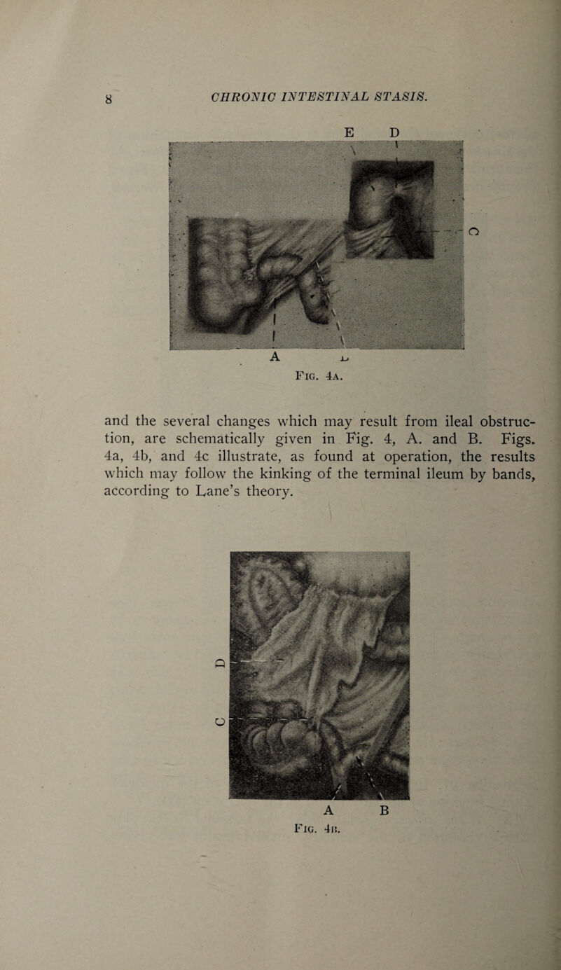 E D A Fig. 4a. and the several changes which may result from ileal obstruc¬ tion, are schematically given in Fig. 4, A. and B. Figs* 4a, 4b, and 4c illustrate, as found at operation, the results which may follow the kinking of the terminal ileum by bands, according to Lane’s theory. A B