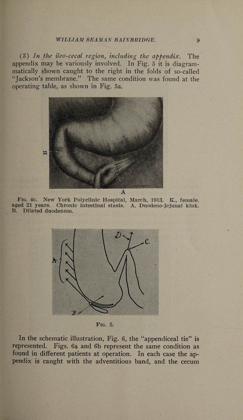 (3) In the ileo-cecal region, including the appendix. The appendix may be variously involved. In Fig. 5 it is diagram- matically shown caught to the right in the folds of so-called “Jackson’s membrane.” The same condition was found at the operating table, as shown in Fig. 5a. A Fig. 4c. New York Polyclinic Hospital, March, 1913. K., female, aged 21 years. Chronic intestinal stasis. A. Duodeno-jejunal kink. B. Dilated duodenum. Fig. 5. In the schematic illustration, Fig. 6, the “appendiceal tie” is represented. Figs. 6a and 6b represent the same condition as found in different patients at operation. In each case the ap¬ pendix is caught with the adventitious band, and the cecum