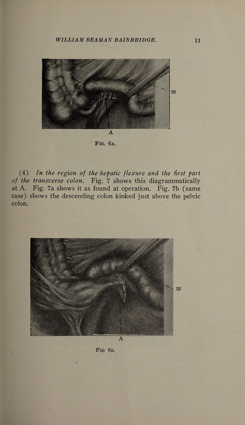 A Fig. 6a. (4) In the region of the hepatic flexure and the first part of the transverse colon. Fig. 7 shows this diagrammatically at A. Fig. 7a shows it as found at operation. Fig. 7b (same case) shows the descending colon kinked just above the pelvic colon. j Fig 6b.