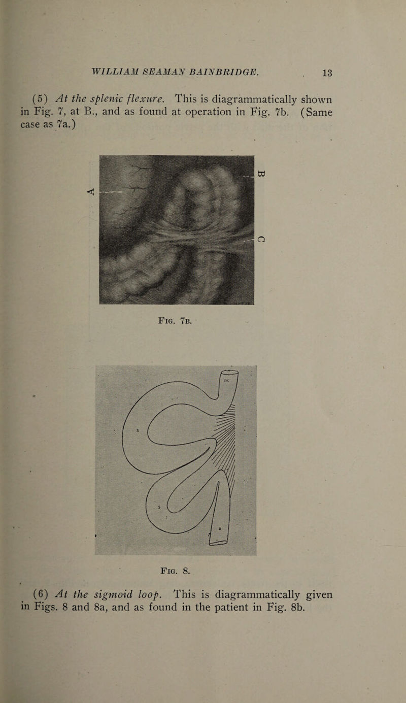 (5) At the splenic flexure. This is diagrammatically shown in Fig. 7, at B., and as found at operation in Fig. 7b. (Same case as 7a.) Fig. 7b. Fig. 8. (6) At the sigmoid loop. This is diagrammatically given in Figs. 8 and 8a, and as found in the patient in Fig. 8b.