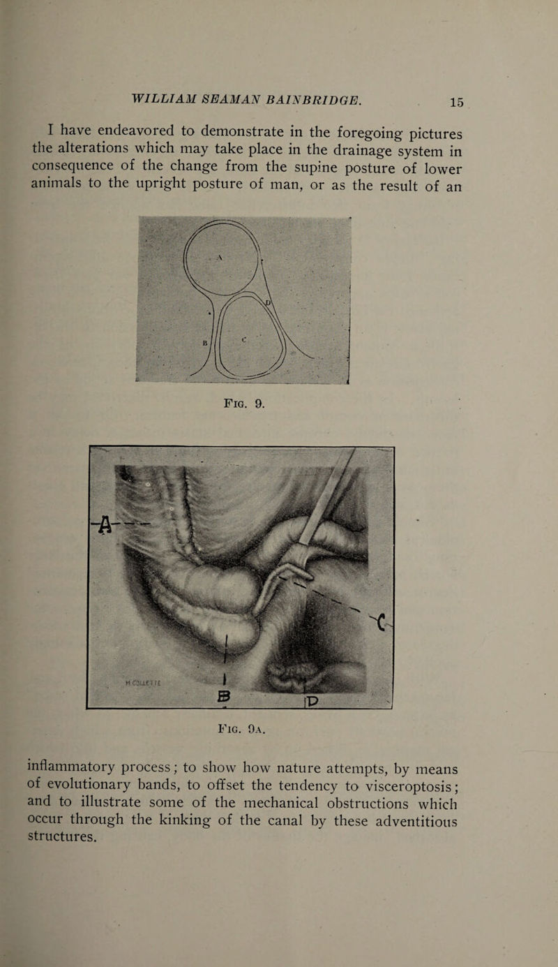 I have endeavored to demonstrate in the foregoing pictures the alterations which may take place in the drainage system in consequence of the change from the supine posture of lower animals to the upright posture of man, or as the result of an Fig. 9. Fig. 9a. inflammatory process; to show how nature attempts, by means of evolutionary bands, to ofifset the tendency to visceroptosis; and to illustrate some of the mechanical obstructions which occur through the kinking of the canal by these adventitious structures.