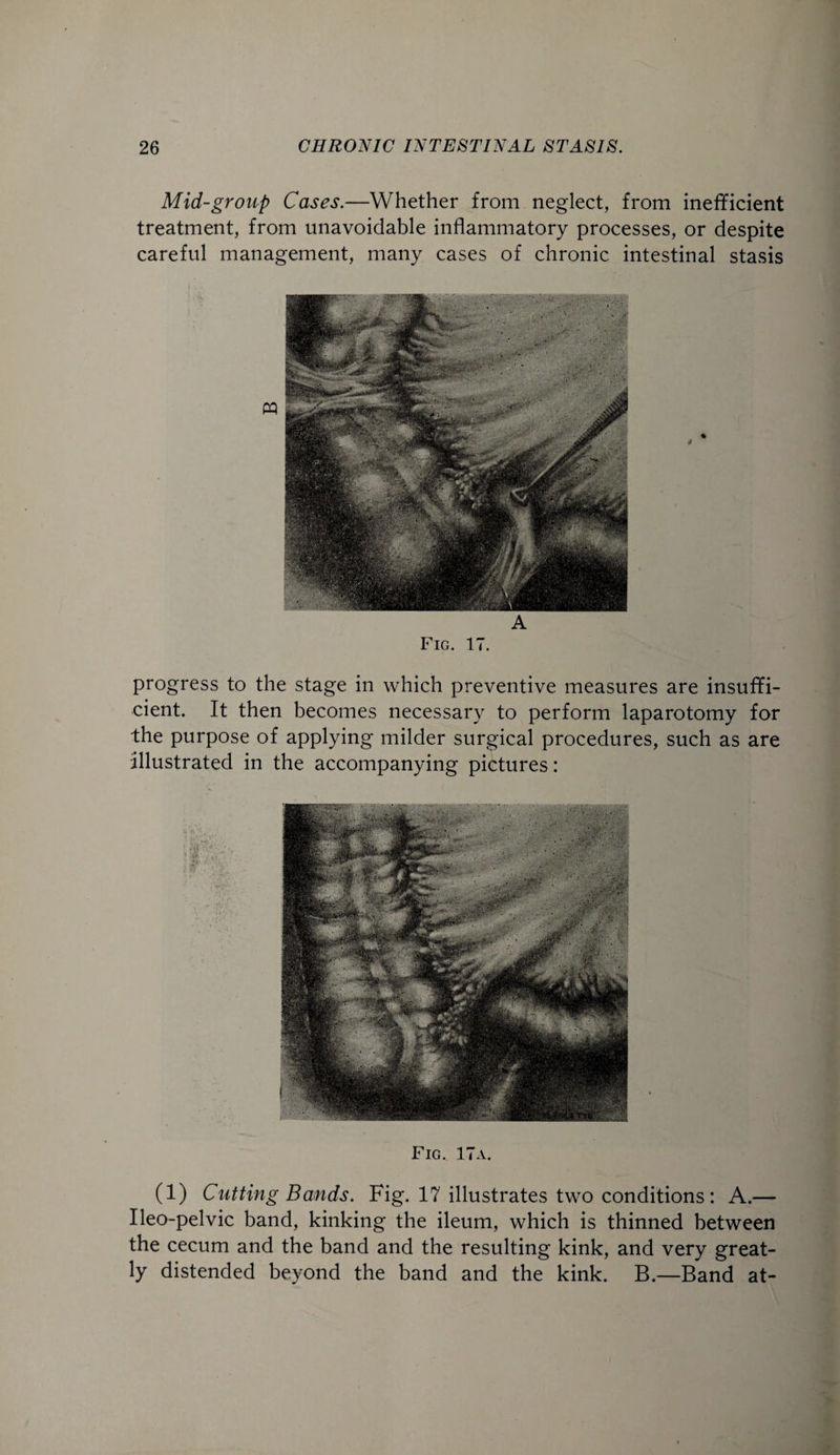 Mid-group Cases.—Whether from neglect, from inefficient treatment, from unavoidable inflammatory processes, or despite careful management, many cases of chronic intestinal stasis A Fig. IT. progress to the stage in which preventive measures are insuffi¬ cient. It then becomes necessary to perform laparotomy for the purpose of applying milder surgical procedures, such as are illustrated in the accompanying pictures: Fig. 17a. (1) Cutting Bands. Fig. 17 illustrates two conditions : A.— Ileo-pelvic band, kinking the ileum, which is thinned between the cecum and the band and the resulting kink, and very great¬ ly distended beyond the band and the kink. B.—Band at-