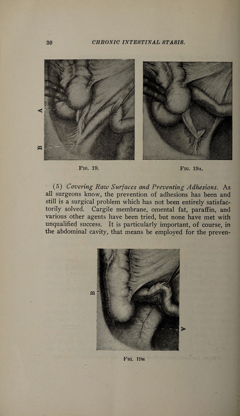 < tt Fig. 19. Fig. 19a. (5) Covering Raw Surfaces and Preventing Adhesions. As all surgeons know, the prevention of adhesions has been and still is a surgical problem which has not been entirely satisfac¬ torily solved. Cargile membrane, omental fat, paraffin, and various other agents have been tried, but none have met with unqualified success. It is particularly important, of course, in the abdominal cavity, that means be employed for the preven-