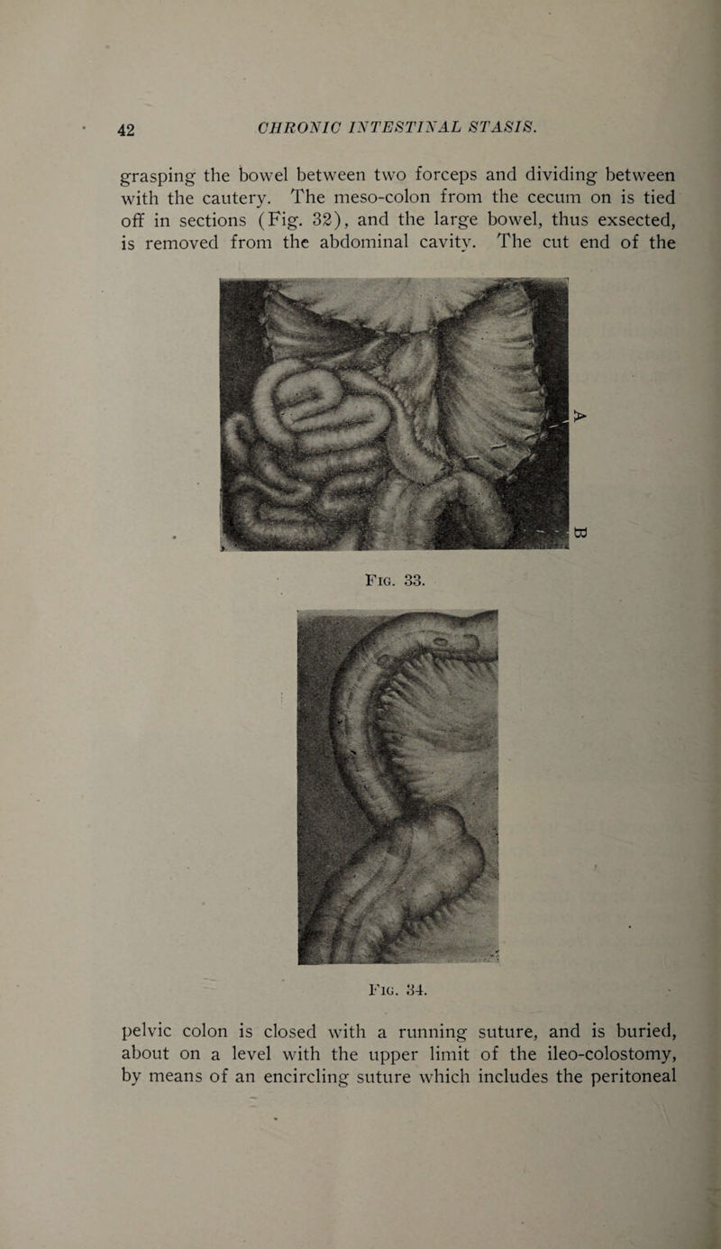 grasping the bowel between two forceps and dividing between with the cautery. The meso-colon from the cecum on is tied off in sections (Fig. 32), and the large bowel, thus exsected, is removed from the abdominal cavity. The cut end of the Fig. 33. Fig. 34. pelvic colon is closed with a running suture, and is buried, about on a level with the upper limit of the ileo-colostomy, by means of an encircling suture which includes the peritoneal