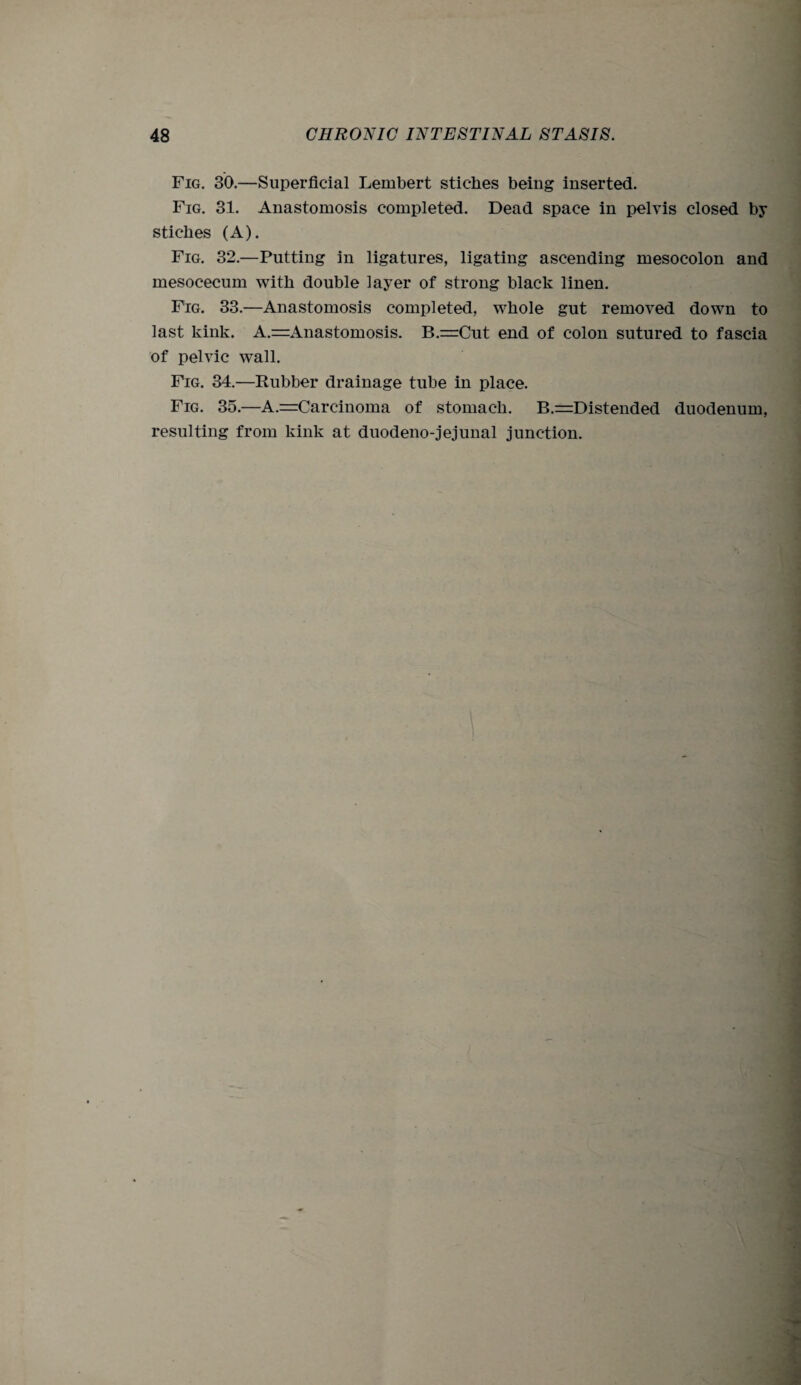 Fig. 30.—Superficial Lembert stic-hes being inserted. Fig. 31. Anastomosis completed. Dead space in pelvis closed by sticlies (A). Fig. 32.—Putting in ligatures, ligating ascending mesocolon and mesocecum with double layer of strong black linen. Fig. 33.—Anastomosis completed, whole gut removed down to last kink. A.=Anastomosis. B.=Cut end of colon sutured to fascia of pelvic wall. Fig. 34.—Rubber drainage tube in place. Fig. 35.—A.=Carcinoma of stomach. B.=Distended duodenum, resulting from kink at duodeno-jejunal junction.