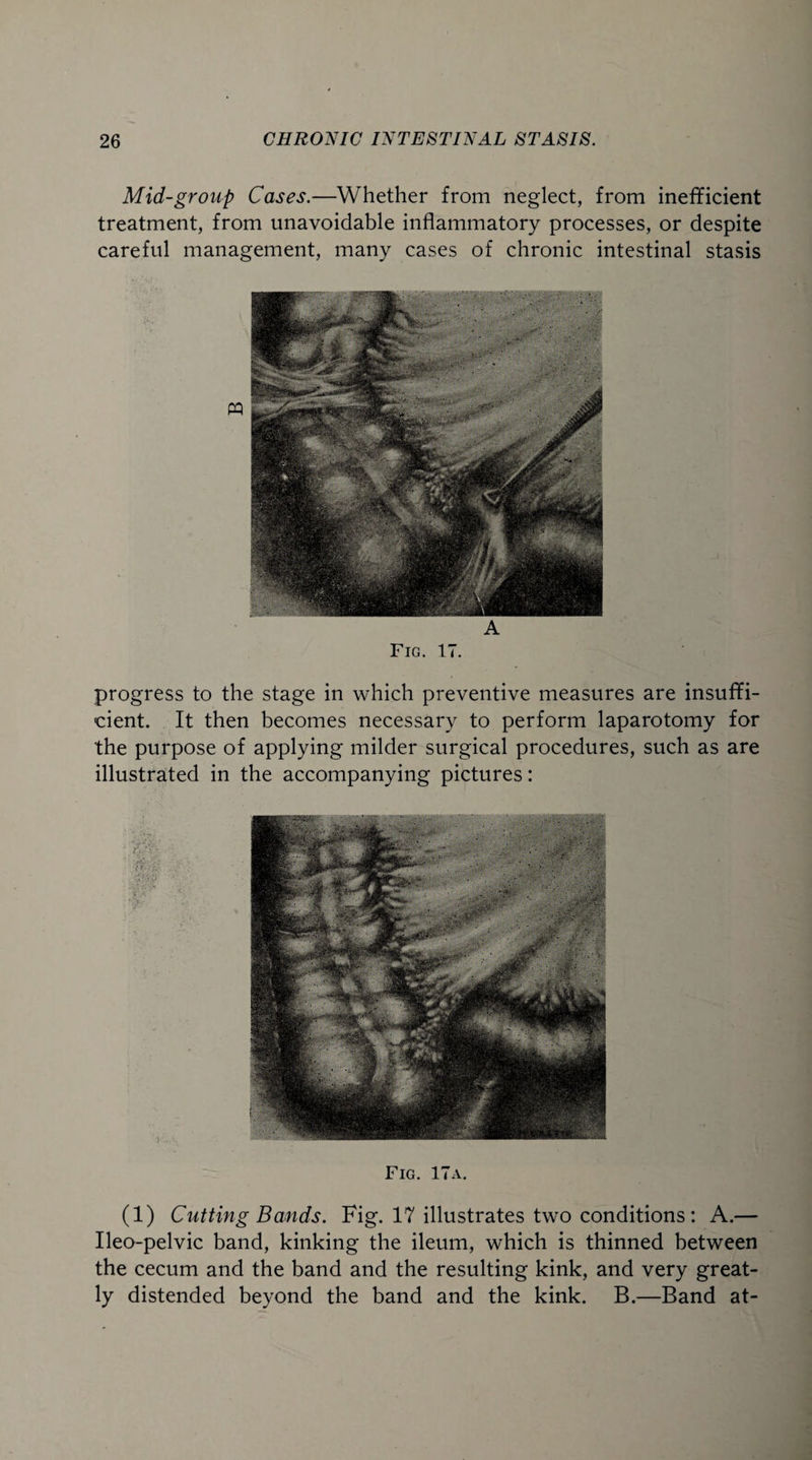 Mid-group Cases.—Whether from neglect, from inefficient treatment, from unavoidable inflammatory processes, or despite careful management, many cases of chronic intestinal stasis A Fig. 17. progress to the stage in which preventive measures are insuffi¬ cient. It then becomes necessary to perform laparotomy for the purpose of applying milder surgical procedures, such as are illustrated in the accompanying pictures: Fig. 17a. (1) Cutting Bands. Fig. 17 illustrates two conditions: A.— Ileo-pelvic band, kinking the ileum, which is thinned between the cecum and the band and the resulting kink, and very great¬ ly distended beyond the band and the kink. B.—Band at-