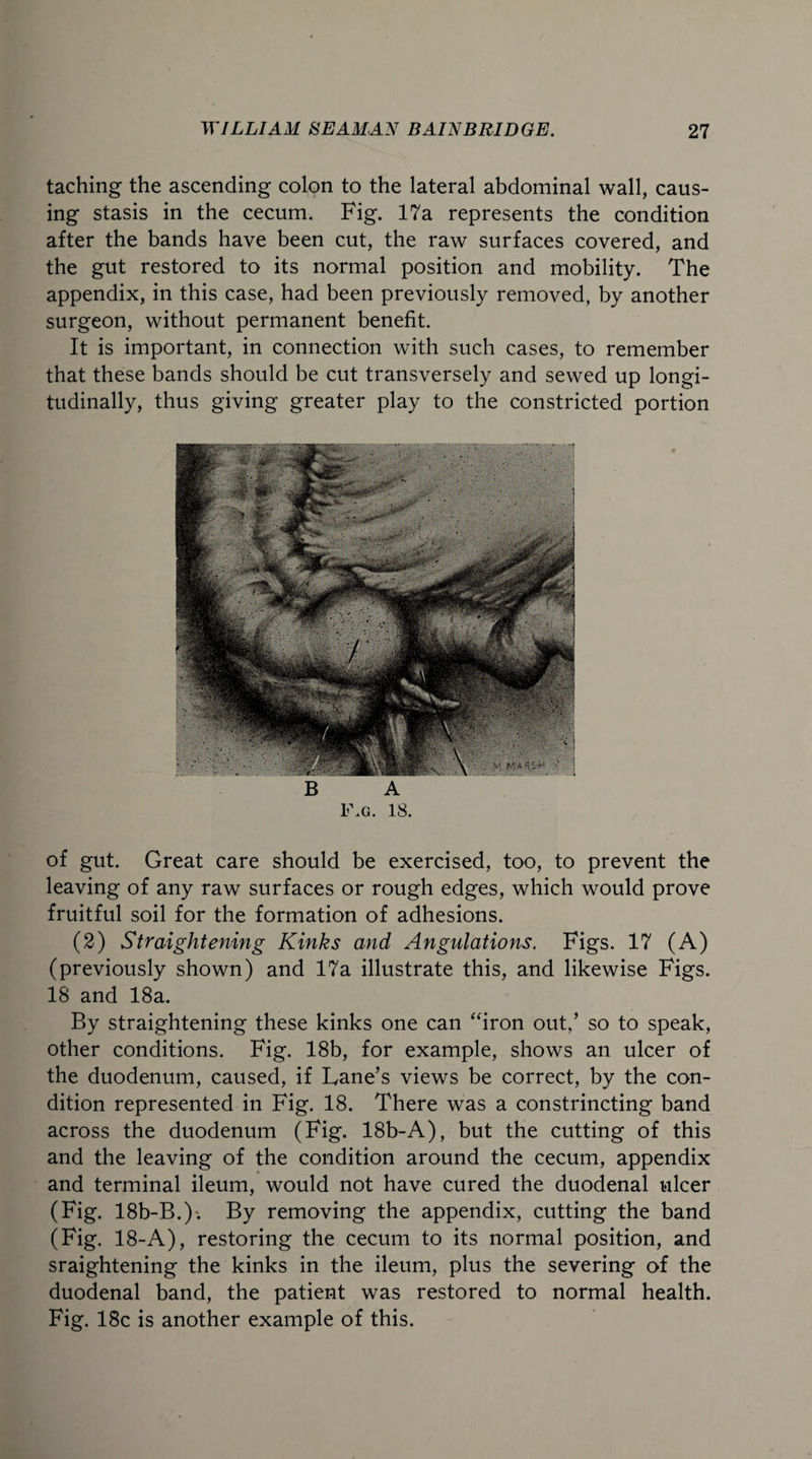 taching the ascending colon to the lateral abdominal wall, caus¬ ing stasis in the cecum. Fig. 17a represents the condition after the bands have been cut, the raw surfaces covered, and the gut restored to its normal position and mobility. The appendix, in this case, had been previously removed, by another surgeon, without permanent benefit. It is important, in connection with such cases, to remember that these bands should be cut transversely and sewed up longi¬ tudinally, thus giving greater play to the constricted portion 1\g. 18. of gut. Great care should be exercised, too, to prevent the leaving of any raw surfaces or rough edges, which would prove fruitful soil for the formation of adhesions. (2) Straightening Kinks and Angulations. Figs. 17 (A) (previously shown) and 17a illustrate this, and likewise Figs. 18 and 18a. By straightening these kinks one can “iron out,’ so to speak, other conditions. Fig. 18b, for example, shows an ulcer of the duodenum, caused, if Fane’s views be correct, by the con¬ dition represented in Fig. 18. There was a constrincting band across the duodenum (Fig. 18b-A), but the cutting of this and the leaving of the condition around the cecum, appendix and terminal ileum, would not have cured the duodenal ulcer (Fig. 18b-B.). By removing the appendix, cutting the band (Fig. 18-A), restoring the cecum to its normal position, and sraightening the kinks in the ileum, plus the severing of the duodenal band, the patient was restored to normal health. Fig. 18c is another example of this.