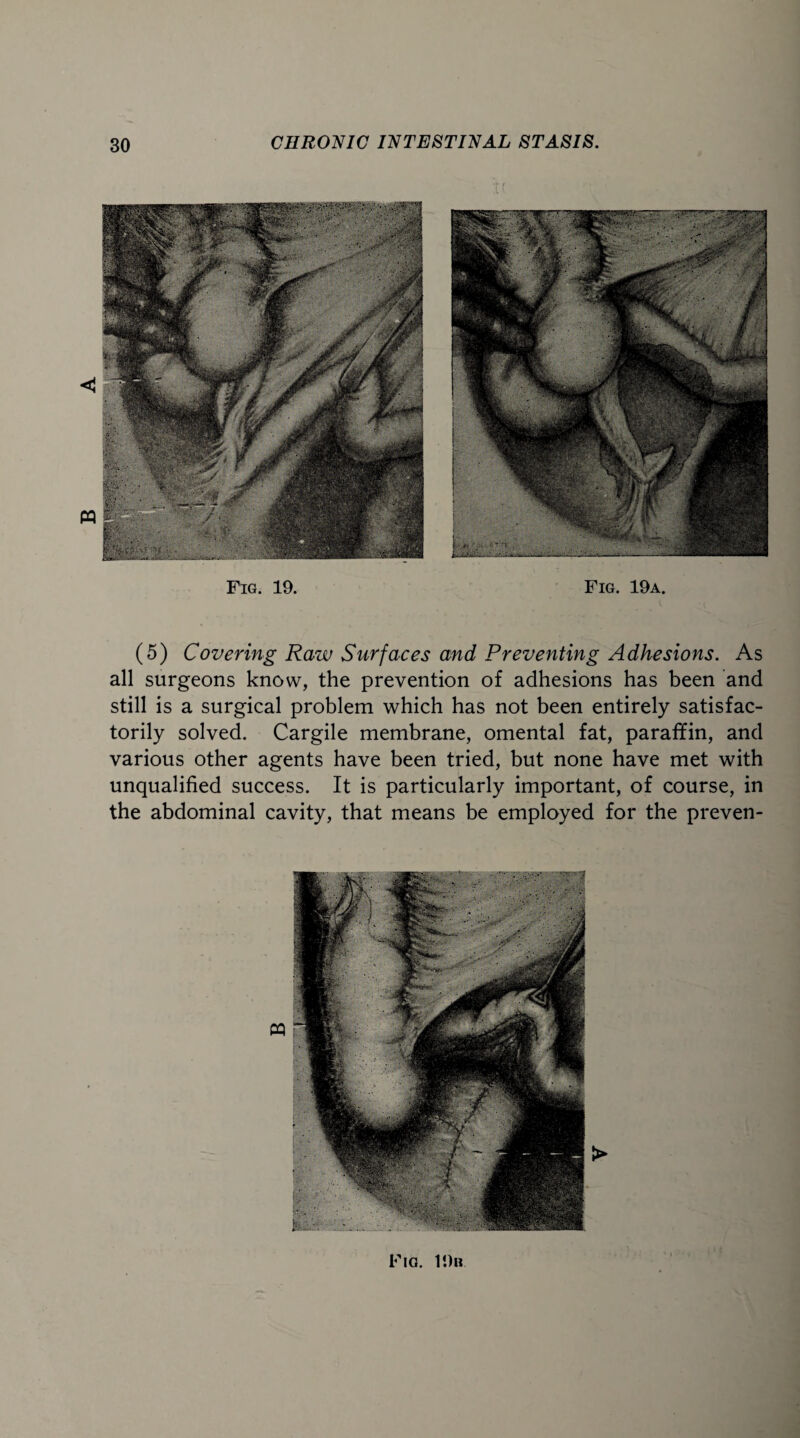 tt Fig. 19. Fig. 19a. (5) Covering Raw Surfaces and Preventing Adhesions. As all surgeons know, the prevention of adhesions has been and still is a surgical problem which has not been entirely satisfac¬ torily solved. Cargile membrane, omental fat, paraffin, and various other agents have been tried, but none have met with unqualified success. It is particularly important, of course, in the abdominal cavity, that means be employed for the preven-