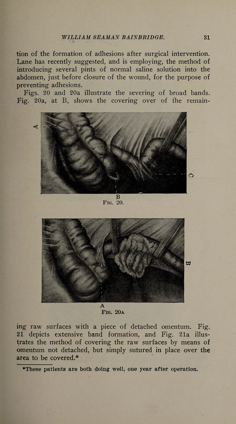 • i tion of the formation of adhesions after surgical intervention. Lane has recently suggested, and is employing, the method of introducing several pints of normal saline solution into the abdomen, just before closure of the wound, for the purpose of preventing adhesions. Figs. 20 and 20a illustrate the severing of broad bands. Fig. 20a, at B, shows the covering over of the remain- B Fig. 20. A Fig. 20a ing raw surfaces with a piece of detached omentum. Fig. 21 depicts extensive band formation, and Fig. 21a illus¬ trates the method of covering the raw surfaces by means of omentum not detached, but simply sutured in place over the area to be covered.* ♦These patients are both doing well, one year after operation.