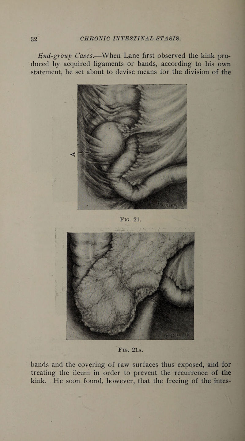 End-group Cases.—When Lane first observed the kink pro¬ duced by acquired ligaments or bands, according to his own statement, he set about to devise means for the division of the Fig. 21a. bands and the covering of raw surfaces thus exposed, and for treating the ileum in order to prevent the recurrence of the kink. He soon found, however, that the freeing of the intes-