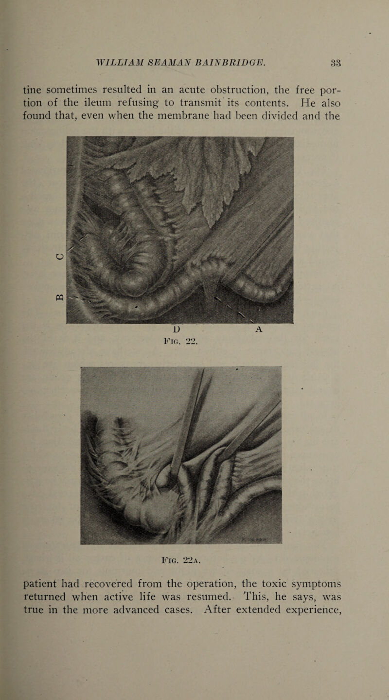 tine sometimes resulted in an acute obstruction, the free por¬ tion of the ileum refusing to transmit its contents. He also found that, even when the membrane had been divided and the Fig. 22a. patient had recovered from the operation, the toxic symptoms returned when active life was resumed. This, he says, was true in the more advanced cases. After extended experience,