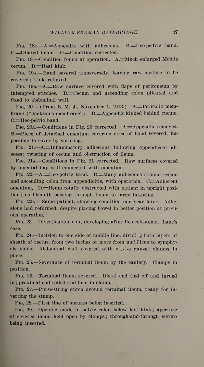 Fig. 18c.—A.=Appendix with adhesions. B.=Ileo-pedvic band. C.=Dilated ileum. D.—Condition corrected. Fig. 19.—Condition found at operation. A.=Much enlarged Mobile cecum. B.=Ueal kink. Fig. 19a.—Band severed transversely, leaving raw surface to be covered; kink relieved. Fig. 19b.—A.=Raw surface covered with flaps of peritoneum by intempted stitches. B—Cecum and ascending colon plicated and fixed to abdominal wall. Fig. 20.— (From B. M. J., November 1, 1913.)—A.=Pericolic mem¬ brane (“Jackson’s membrane”). B.=Appendix kinked behind cucurn. C.=Ileo-pelvic band. Fig. 20a.—Conditions in Fig. 20 corrected. A.—Appendix removed. B.=Piece of detached omentum covering area of band severed, im¬ possible to cover by suturing. Fig. 21.—A.=Inflammatory adhesions following appendiceal ab¬ scess ; twisting of cecum and obstruction of ileum. Fig. 21a.—Conditions in Fig. 21 corrected. Raw surfaces covered by omental flap still connected with omentum. Fig. 22.—A.=Ileo-pelvic band. B.=Many adhesions around cecum and ascending colon from appendicitis, with operation. C.=Adlierent omentum. D.=Ileum totally obstructed with patient in upright posi¬ tion; no bismuth passing through ileum to large intestine. Fig. 22a.—Same patient, showing condition one year later. Adhe¬ sions had reformed, despite placing bowel in better position at previ¬ ous operation. Fig. 23.—Diverticulum (A), developing after ileo-colostomy. Lane’s case. Fig. 24.—Incision to one side of middle line, dividi g both layers of sheath of rectus, from two inches or more from umbilicus to symphy¬ sis pubis. Abdominal wall covered with sf;,i.be gauze; clamps in place. Fig. 25.—Severance of terminal ileum by the cautery. Clamps in position. Fig. 26.—Terminal ileum severed. Distal end tied off and turned in; proximal end rolled and held in clamp. Fig. 27.—Purse-string stitch around terminal ileum, ready for in¬ verting the stump. Fig. 28.—First line of sutures being inserted. Fig. 29.—Opening made in pelvic colon below last kink; aperture of severed ileum held open by clamps; through-and-through suture being inserted.