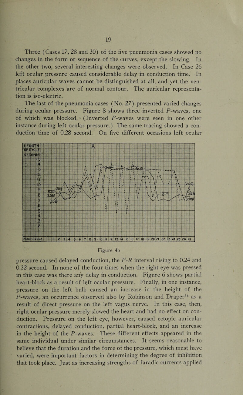 Three (Cases 17, 28 and 30) of the five pneumonia cases showed no changes in the form or sequence of the curves, except the slowing. In the other two, several interesting changes were observed. In Case 26 left ocular pressure caused considerable delay in conduction time. In places auricular waves cannot be distinguished at all, and yet the ven¬ tricular complexes are of normal contour. The auricular representa¬ tion is iso-electric. The last of the pneumonia cases (No. 27) presented varied changes during ocular pressure. Figure 8 shows three inverted P-waves, one of which was blocked. (Inverted P-waves were seen in one other instance during left ocular pressure.) The same tracing showed a con¬ duction time of 0.28 second. On five different occasions left ocular Figure 4b pressure caused delayed conduction, the P-R interval rising to 0.24 and 0.32 second. In none of the four times when the right eye was pressed in this case was there any delay in conduction. Figure 6 shows partial heart-block as a result of left ocular pressure. Finally, in one instance, pressure on the left bulb caused an increase in the height of the P-waves, an occurrence observed also by Robinson and Draper34 as a result of direct pressure on the left vagus nerve. In this case, then, right ocular pressure merely slowed the heart and had no effect on con¬ duction. Pressure on the left eye, however, caused ectopic auricular contractions, delayed conduction, partial heart-block, and an increase in the height of the P-waves. These different effects appeared in the same individual under similar circumstances. It seems reasonable to believe that the duration and the force of the pressure, which must have varied, were important factors in determining the degree of inhibition that took place. Just as increasing strengths of faradic currents applied