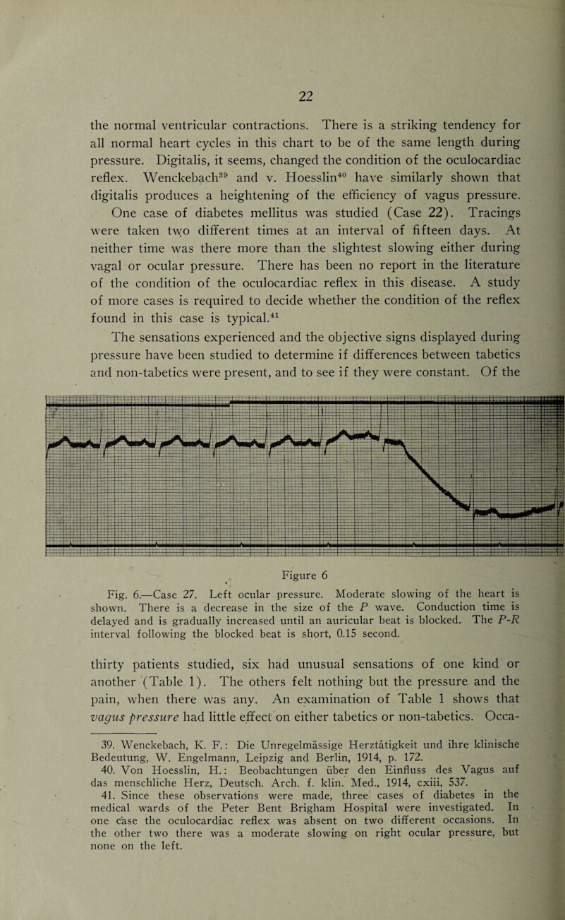 the normal ventricular contractions. There is a striking tendency for all normal heart cycles in this chart to be of the same length during pressure. Digitalis, it seems, changed the condition of the oculocardiac reflex. Wenckebach39 and v. Hoesslin40 have similarly shown that digitalis produces a heightening of the efficiency of vagus pressure. One case of diabetes mellitus was studied (Case 22). Tracings were taken t\yo different times at an interval of fifteen days. At neither time was there more than the slightest slowing either during vagal or ocular pressure. There has been no report in the literature of the condition of the oculocardiac reflex in this disease. A study of more cases is required to decide whether the condition of the reflex found in this case is typical.41 The sensations experienced and the objective signs displayed during pressure have been studied to determine if differences between tabetics and non-tabetics were present, and to see if they were constant. Of the X I Figure 6 « Fig. 6.—Case 27. Left ocular pressure. Moderate slowing of the heart is shown. There is a decrease in the size of the P wave. Conduction time is delayed and is gradually increased until an auricular beat is blocked. The P-R interval following the blocked beat is short, 0.15 second. thirty patients studied, six had unusual sensations of one kind or another (Table 1). The others felt nothing but the pressure and the pain, when there was any. An examination of Table 1 shows that vagus pressure had little effect on either tabetics or non-tabetics. Occa- 39. Wenckebach, K. F.: Die Unregelmassige Herztatigkeit und ihre klinische Bedeutung, W. Engelmann, Leipzig and Berlin, 1914, p. 172. 40. Von Floesslin, H.: Beobachtungen fiber den Einfluss des Vagus auf das menschliche Herz, Deutsch. Arch. f. klin. Med., 1914, cxiii, 537. 41. Since these observations were made, three cases of diabetes in the medical wards of the Peter Bent Brigham Hospital were investigated. In one case the oculocardiac reflex was absent on two different occasions. In the other two there was a moderate slowing on right ocular pressure, but none on the left.