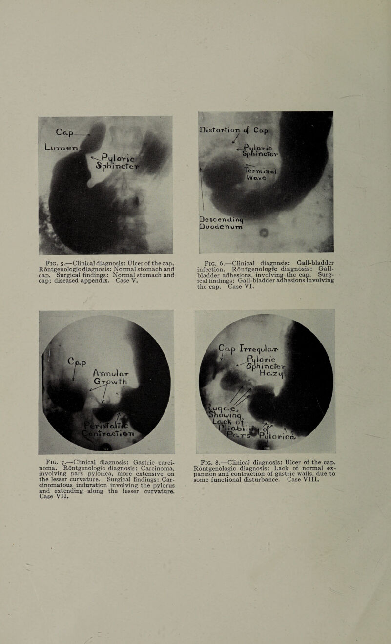 Rontgenologic diagnosis: Normal stomach and cap. Surgical findings: Normal stomach and cap; diseased appendix. Case V. Fig. 7-—Clinical diagnosis: Gastric carci¬ noma. Rontgenologic diagnosis: Carcinoma, involving pars pylorica, more extensive on the lesser curvature. Surgical findings: Car¬ cinomatous induration involving the pylorus and extending along the lesser curvature. Case VII. infection. Rontgenologic diagnosis: Gall¬ bladder adhesions, involving the cap. Surg¬ ical findings: Gall-bladder adhesions involving the cap. Case VI. Fig. 8.—Clinical diagnosis: Ulcer of the cap. Rontgenologic diagnosis: Lack of normal ex¬ pansion and contraction of gastric walls, due to some functional disturbance. Case VIII.