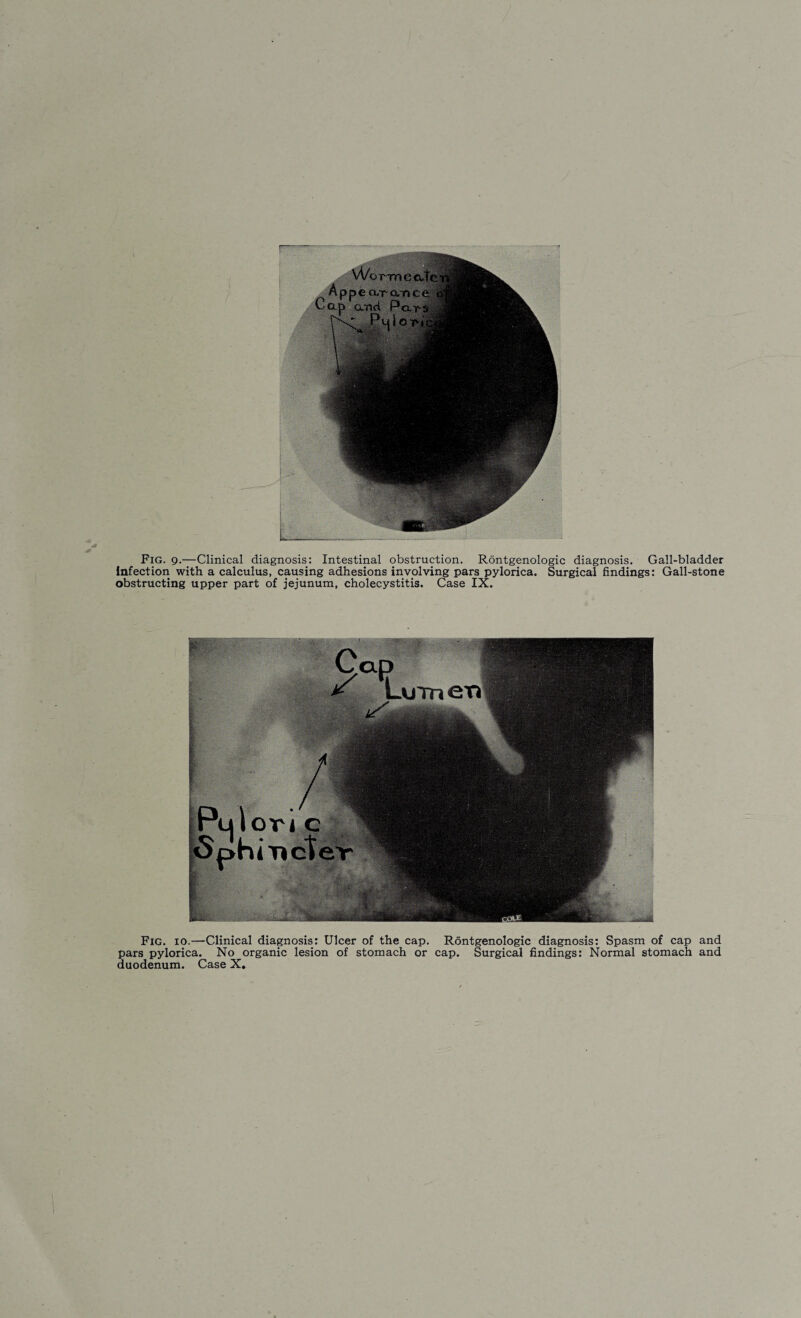 4* Fig. 9.—Clinical diagnosis: Intestinal obstruction. Rontgenologic diagnosis. Gall-bladder Infection with a calculus, causing adhesions involving pars pylorica. Surgical findings: Gall-stone obstructing upper part of jejunum, cholecystitis. Case IX. Fig. io.—Clinical diagnosis: Ulcer of the cap. Rontgenologic diagnosis: Spasm of cap and pars pylorica. No organic lesion of stomach or cap. Surgical findings: Normal stomach and duodenum. Case X.