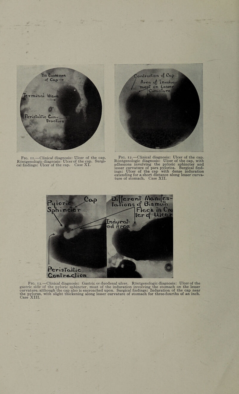 Rontgenologic diagnosis: Ulcer of the cap. Surgi¬ cal findings: Ulcer of the cap. Case XI. Rontgenologic diagnosis: Ulcer of the cap, with adhesions involving the pyloric sphincter and lesser curvature of pars pylorica. Surgical find¬ ings: Ulcer of the cap with dense induration extending for a short distance along lesser curva¬ ture of stomach. Case XII. Fig. 13.—Clinical diagnosis: Gastric or duodenal ulcer. Rontgenologic diagnosis: Ulcer of the gastric side of the pyloric sphincter, most of the induration involving the stomach on the lesser curvature, although the cap also is encroached upon. Surgical findings: Induration of the cap near the pylorus, with slight thickening along lesser curvature of stomach for three-fourths of an inch. Case XIII.