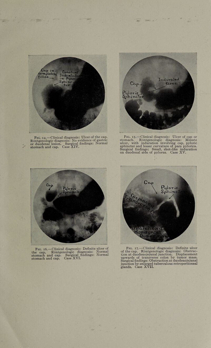 Rontgenologic diagnosis: No evidence of gastric or duodenal lesion. Surgical findings: Normal stomach and cap. Case XIV. Fig. 16.—Clinical diagnosis: Definite ulcer of the cap. Rontgenologic diagnosis: Normal stomach and cap. Surgical findings: Normal stomach and cap. Case XVI. stomach. Rontgenologic diagnosis: Minute ulcer, with induration involving cap, pyloric sphincter and lesser curvature of pars pylorica. Surgical findings: Small, shot-like induration on duodenal side of pylorus. Case XV. Fig. 17.—Clinical diagnosis: Definite ulcer of the cap. Rontgenologic diagnosis: Obstruc¬ tion at duodenojejunal junction. Displacement upwards of transverse colon by tumor mass. Surgical findings: Obstruction at duodenojejunal junction by enlarged tuberculous retroperitoneal glands. Case XVII.