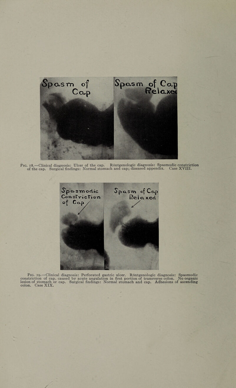 Fig. 18.—Clinical diagnosis: Ulcer of the cap. Rontgenologic diagnosis: Spasmodic constriction of the cap. Surgical findings: Normal stomach and cap; diseased appendix. Case XVIII. Fig. 19.—Clinical diagnosis: Perforated gastric ulcer. Rontgenologic diagnosis: Spasmodic constriction of cap, caused by acute angulation in first portion of transverse colon. No organic lesion of stomach or cap. Surgical findings: Normal stomach and cap. Adhesions of ascending colon. Case XIX.