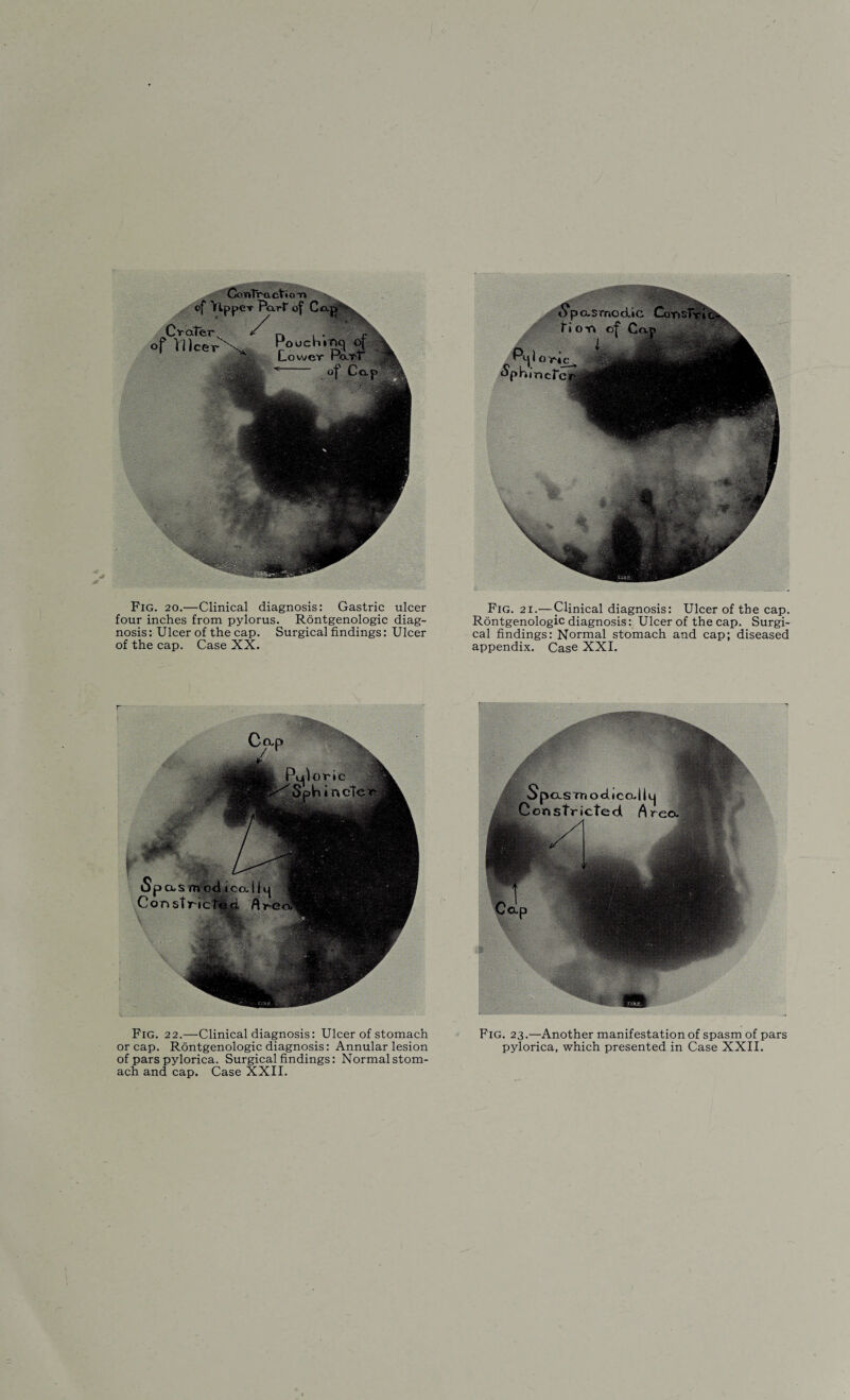 Fig. 20.—Clinical diagnosis: Gastric ulcer four inches from pylorus. Rontgenologic diag¬ nosis: Ulcer of the cap. Surgical findings: Ulcer of the cap. Case XX. Fig. 21.— Clinical diagnosis: Ulcer of the cap. Rontgenologic diagnosis: Ulcer of the cap. Surgi¬ cal findings: Normal stomach and cap; diseased appendix. Case XXI. Fig. 22.—Clinical diagnosis: Ulcer of stomach or cap. Rontgenologic diagnosis: Annular lesion of pars pylorica. Surgical findings: Normal stom¬ ach and cap. Case XXII. Fig. 23.—Another manifestation of spasm of pars pylorica, which presented in Case XXII.