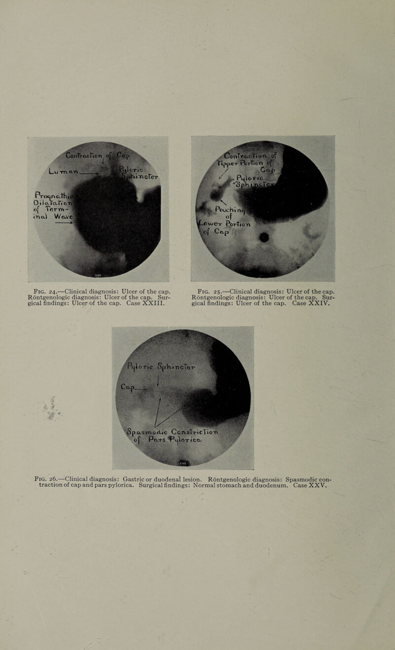 Rontgenologic diagnosis: Ulcer of the cap. Sur¬ gical findings: Ulcer of the cap. Case XXIII. Rontgenologic diagnosis: Ulcer of the cap. Sur¬ gical findings: Ulcer of the cap. Case XXIV. Fig. 26.—Clinical diagnosis: Gastric or duodenal lesion. Rontgenologic diagnosis: Spasmodic con¬ traction of cap and pars pylorica. Surgical findings: Normal stomach and duodenum. Case XXV.