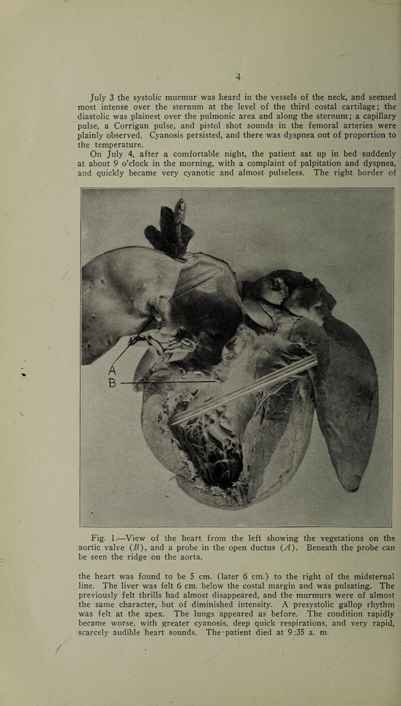 July 3 the systolic murmur was heard in the vessels of the neck, and seemed most intense over the sternum at the level of the third costal cartilage; the diastolic was plainest over the pulmonic area and along the sternum; a capillary pulse, a Corrigan pulse, and pistol shot sounds in the femoral arteries were plainly observed. Cyanosis persisted, and there was dyspnea out of proportion to the temperature. On July 4, after a comfortable night, the patient sat up in bed suddenly at about 9 o’clock in the morning, with a complaint of palpitation and dyspnea, and quickly became very cyanotic and almost pulseless. The right border of Fig. 1.—View of the heart from the left showing the vegetations on the aortic valve (B), and a probe in the open ductus (A). Beneath the probe can be seen the ridge on the aorta. the heart was found to be 5 cm. (later 6 cm.) to the right of the midsternal line. The liver was felt 6 cm. below the costal margin and was pulsating. The previously felt thrills had almost disappeared, and the murmurs were of almost the same character, but of diminished intensity. A presystolic gallop rhythm was felt at the apex. The lungs appeared as before. The condition rapidly became worse, with greater cyanosis, deep quick respirations, and very rapid, scarcely audible heart sounds. The-patient died at 9:35 a. m.