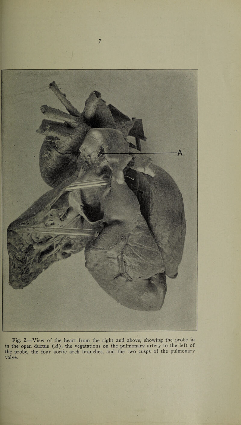 Fig. 2.—View of the heart from the right and above, showing the probe in in the open ductus (A), the vegetations on the pulmonary artery to the left of the probe, the four aortic arch branches, and the two cusps of the pulmonary valve.